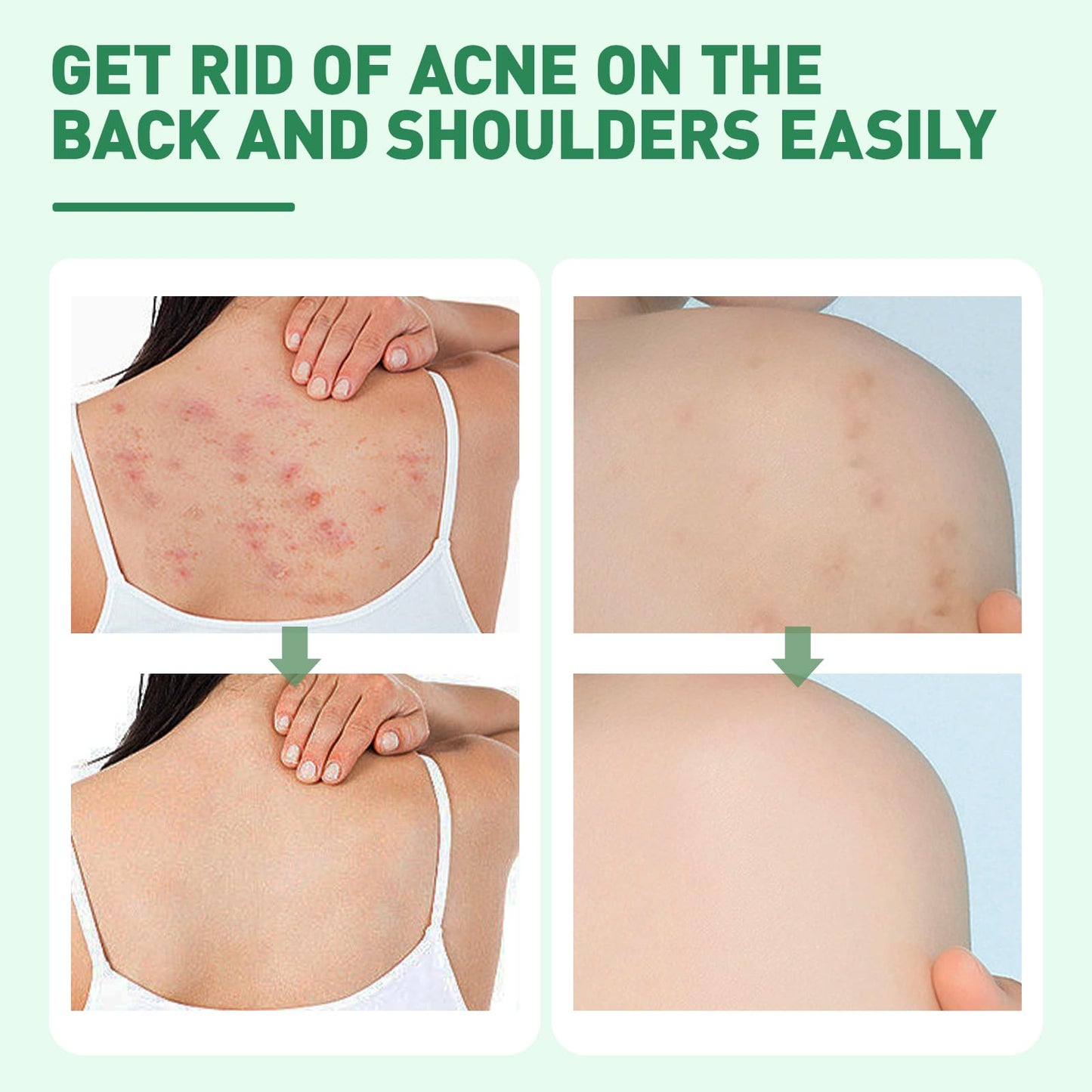 Back Acne Treatment Spray With Herbal Formula, 2% Salicylic Acid & Tea Tree Oil - Body Acne Solution, 120ml