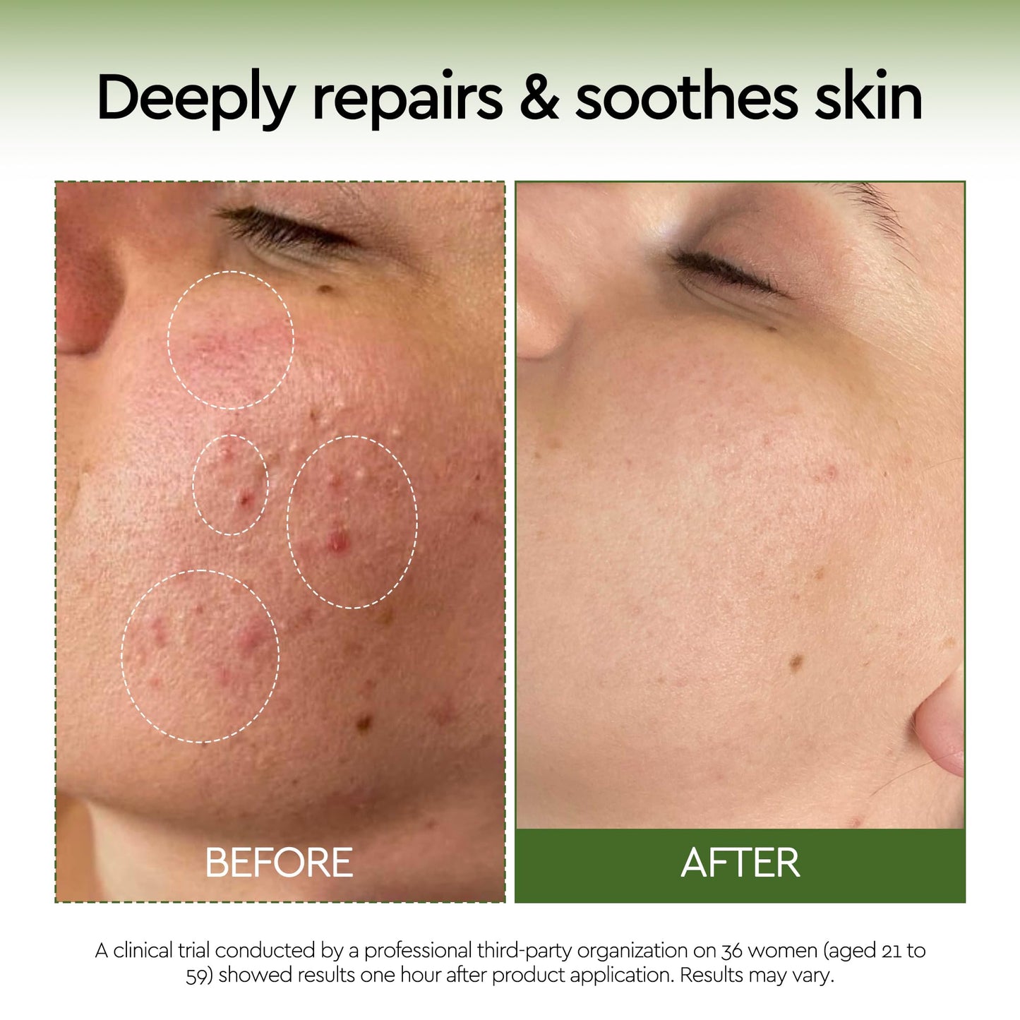 10% Azelaic Acid Serum Redness Soothing Face Serum with Niacinamide & Centella Asiatica Hydrating Acne Treatment for Sensitive Skin Azelaic Acid Formula Centella Asiatica CICA Facial Serum Skin Care