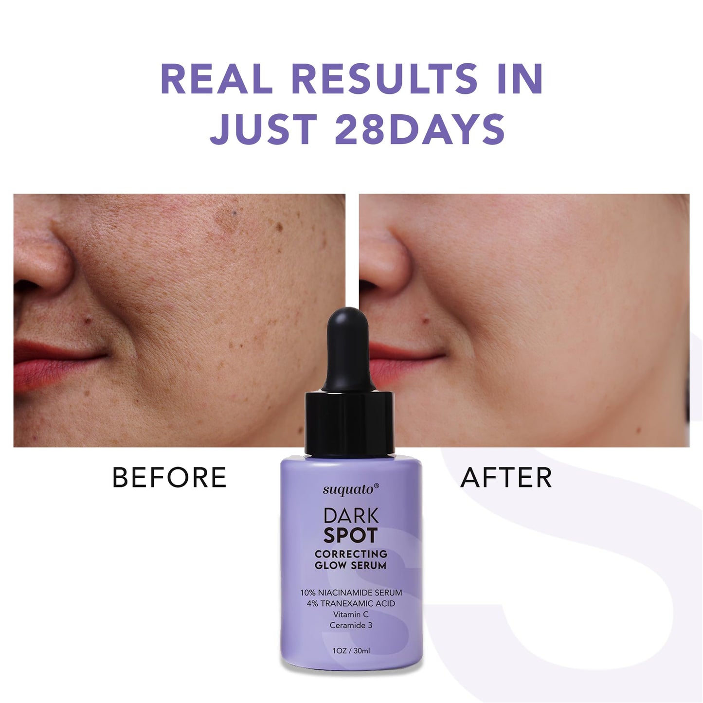suquato Dark Spot Remover Serum – For Face Hyperpigmentation & Melasma Care – Dark Spot Correcting Glow with Tranexamic Acid + Niacinamide + Vitamin C (30ml)