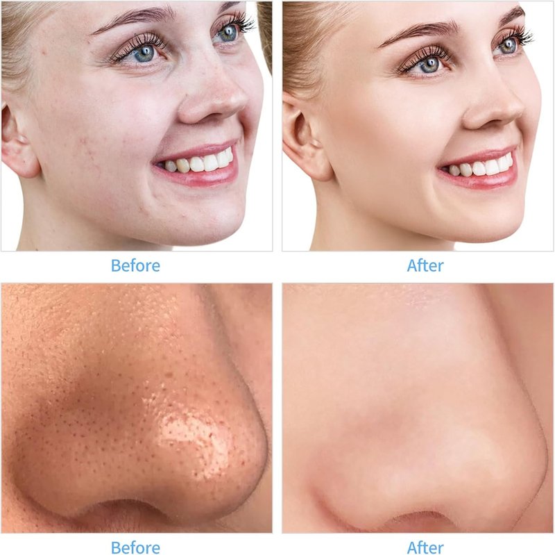 Diamond Microdermabrasion Machine - Portable USB Skin Exfoliation Device | Cordless Blackhead Remover for Women