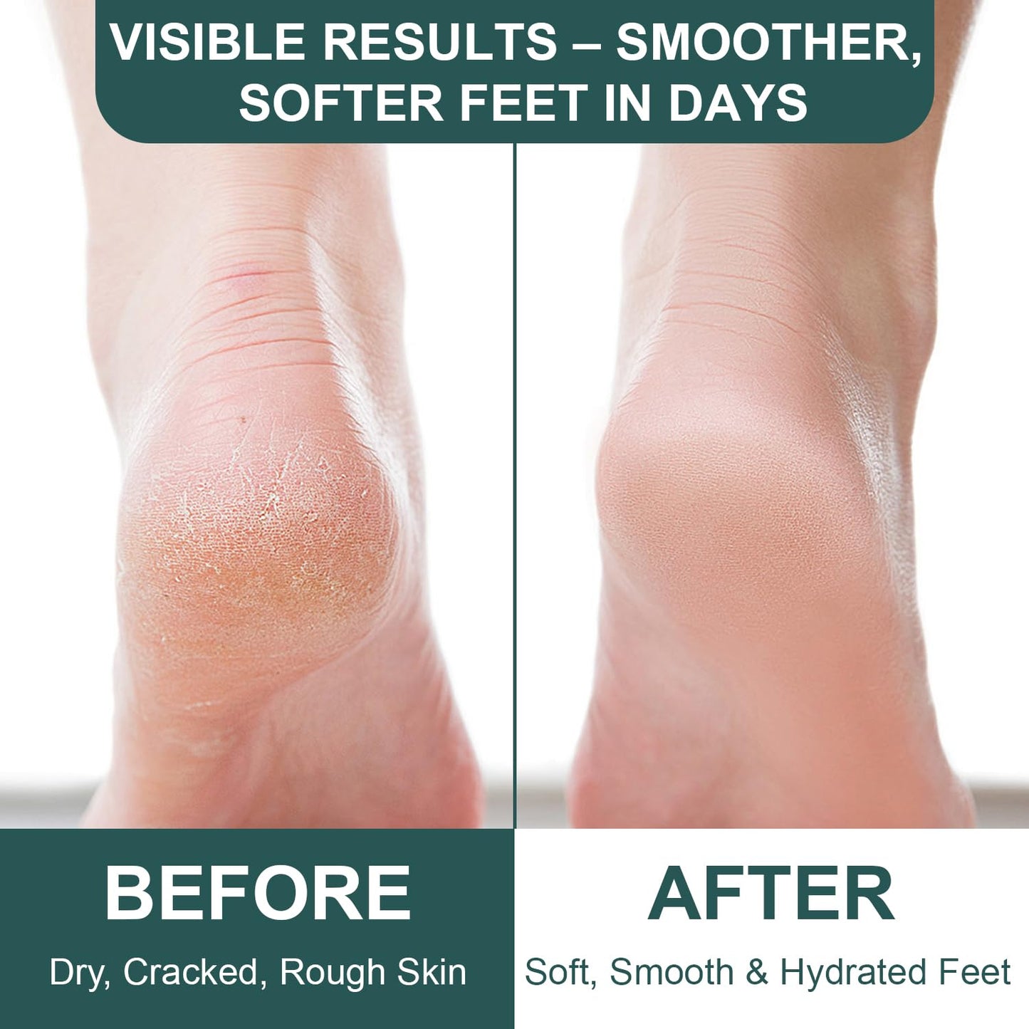 Urea Cream 60 Percent For Feet Maximum Strength with Salicylic Acid 8.45 oz