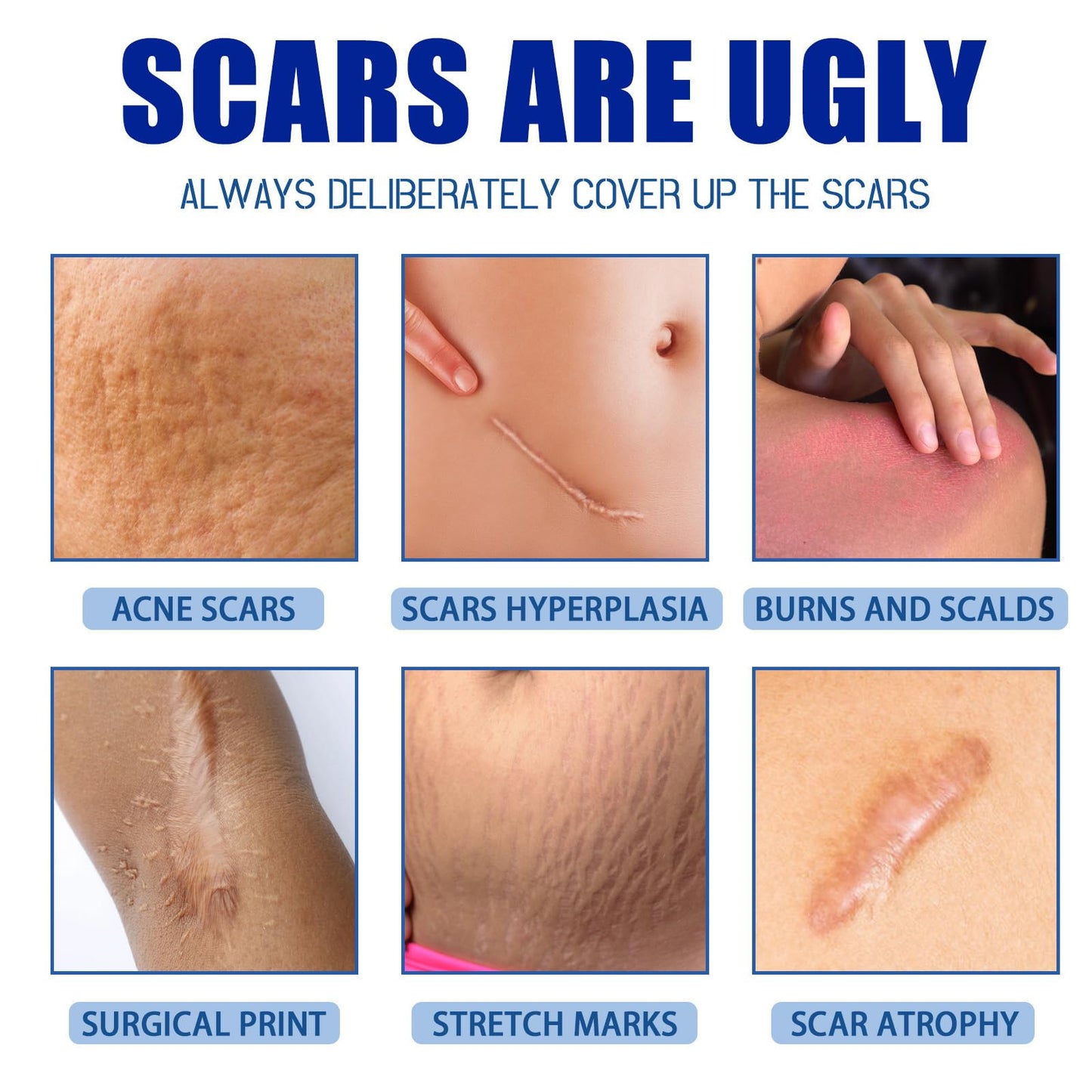 Scar Cream,Scar Removal Cream,Silicone Scar Gel,Scar Silicone Gel,Scar Gel,Scar Cream for Surgical Scars, Stretch Marks and Keloid Bump (1pcs)