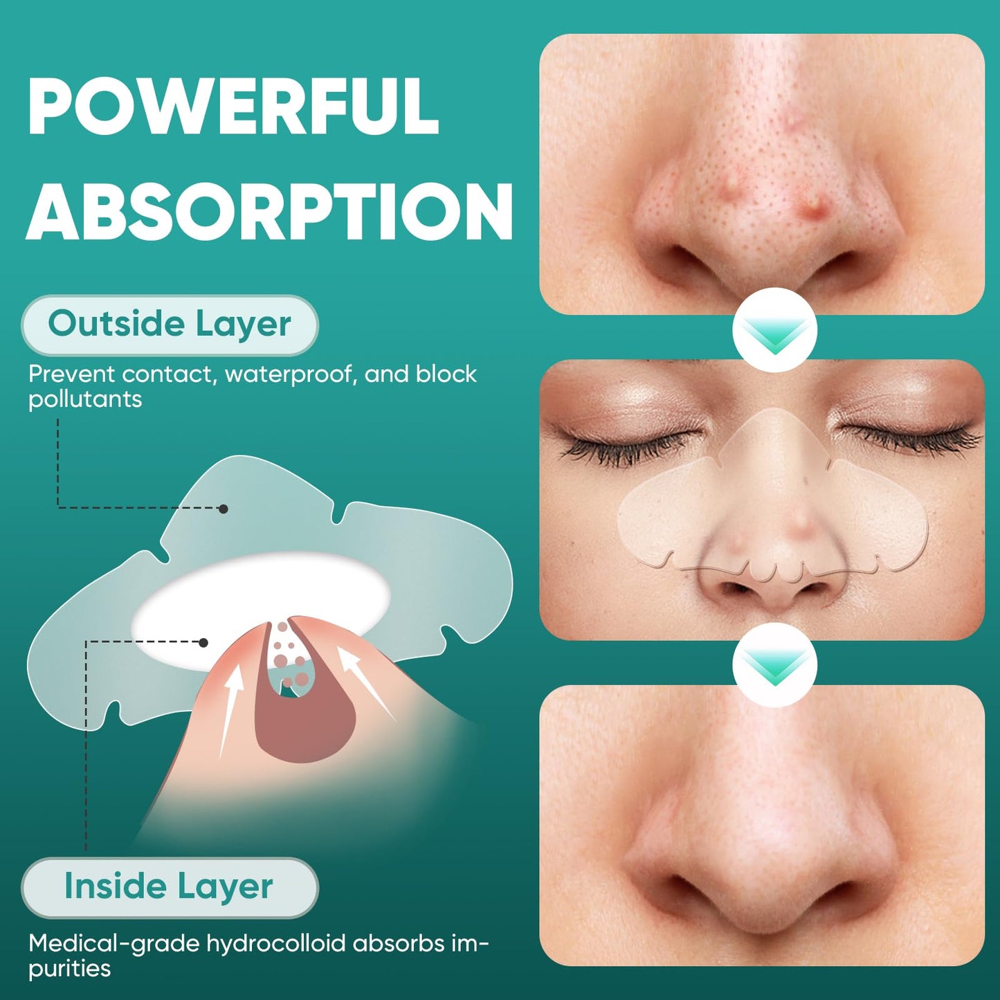 kindshine 30 Count Nose Pore Patches, Medical-Grade Hydrocolloid Pore Strips, Overnight Oil-Absorbing & Pore-Refining, Pimple Stickers to Absorb Acne Nose Gunk