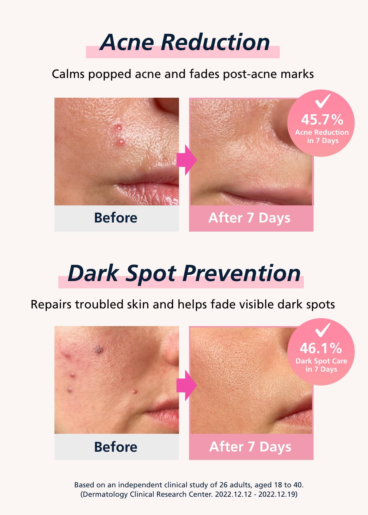 Easyderm Real Calming Patch Microdart Pimple Patches, Clear Nano Micropoint | Niacinamide, Hyaluronic Acid, EGF Acne Dark Spot Care, K-beauty | 12 Counts Summer & Travel Essentials