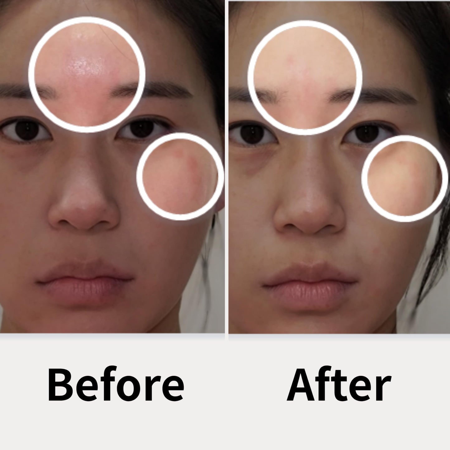 AD SOLUTION Ato Fast Calming Patch for Skin Redness, Itching & Flare-Ups – Soothing Hydrogel for Sensitive Skin with Cica & Panthenol – 10 Pairs