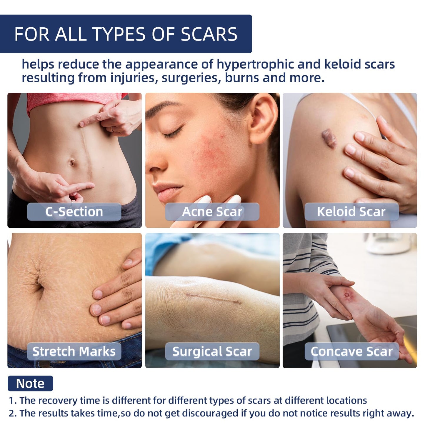 Silicone Scar Gel, Scar Cream for Face & Body, Advanced Scar Cream Gel for Old & New Scars, Stretch Marks, Surgery, Burns, C-Section 30g (1.06 Oz)