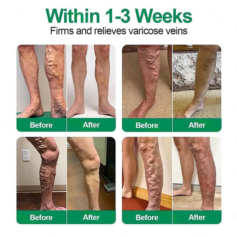 Healrize Vein Target Microdarts Patch - Natural Varicose Vein Treatment for All Skin Types | 1 Box