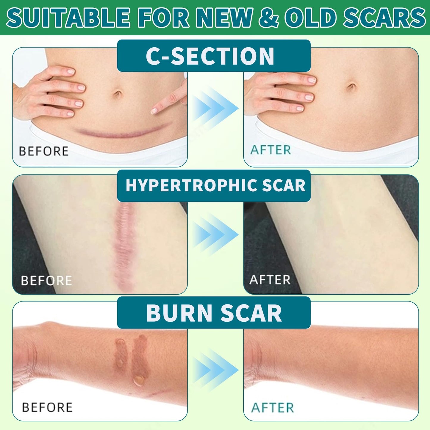 2 Pack Silicone Scar Sheets, Silicone Scar Tape, Scar Sheets for Surgical Scars, Reusable Silicone Scar Strip For Surgical, C-Section,Tummy Tuck, Keloid Scars, Burn, Acne, Removal