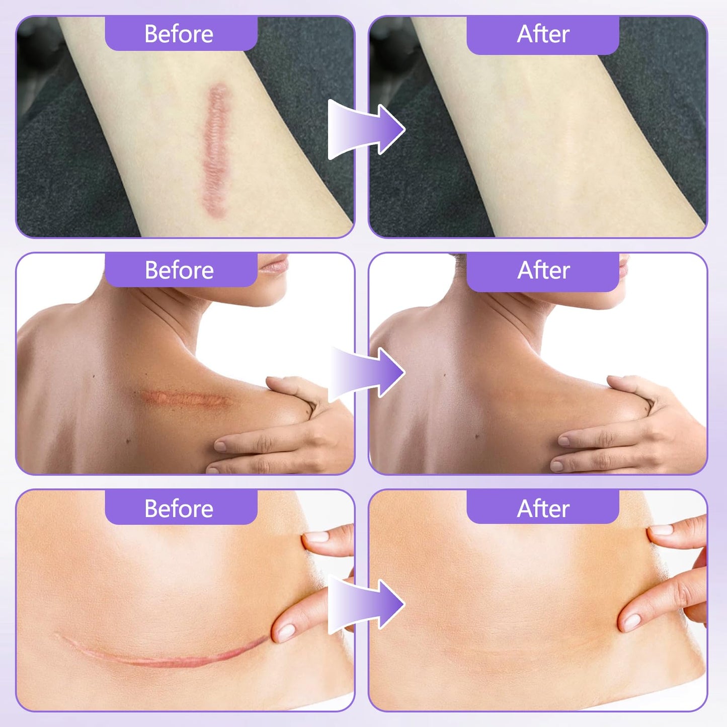 Collagen Tape, Collagen Sheets for Scars & Wrinkle, Silicone Scar Removal Strips for Various Different Scars and Wrinkles, for Surgeries Burn Acne Wounds Recovery