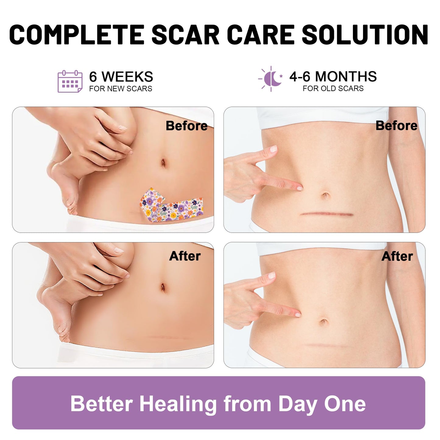 SLGCBL Silicone Scar Tape for Surgical Scars, Silicone Scar Sheets, C Section, Tummy Tuck (1.6”x 60”-1.5M) Reusable Scar Removal Strips for Face, Body, Burns & Keloid Scars