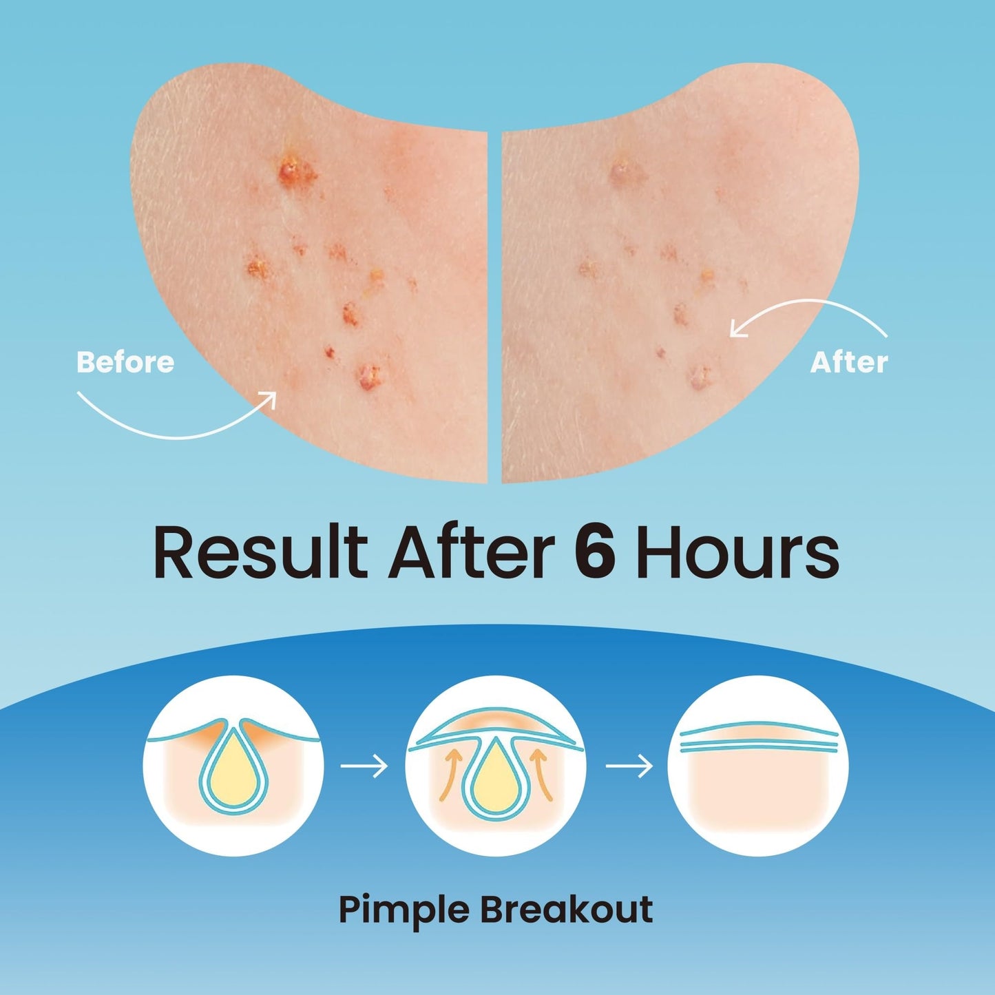 DERMA ANGEL Large Pimple Patches for Nose Chin and Forehead Pores Breakout and Spot Treatment - Acne Patches for Face Hydrocolloid Acne Patches Zit Patches for Face Big Pimple Patches - 16 Patches XL