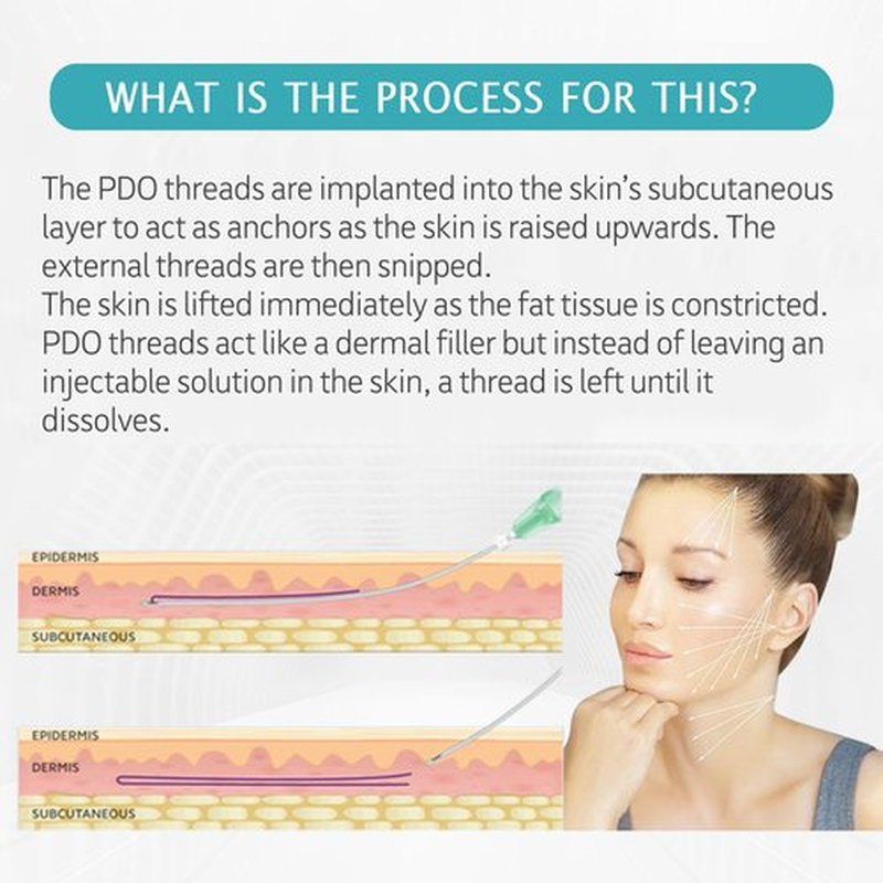ESTEVO PDO Mono Threads Lift, for Face and Body PDO Thread For Skin Tightening and Reduce Wrinkle (20PCS-29G*50mm)