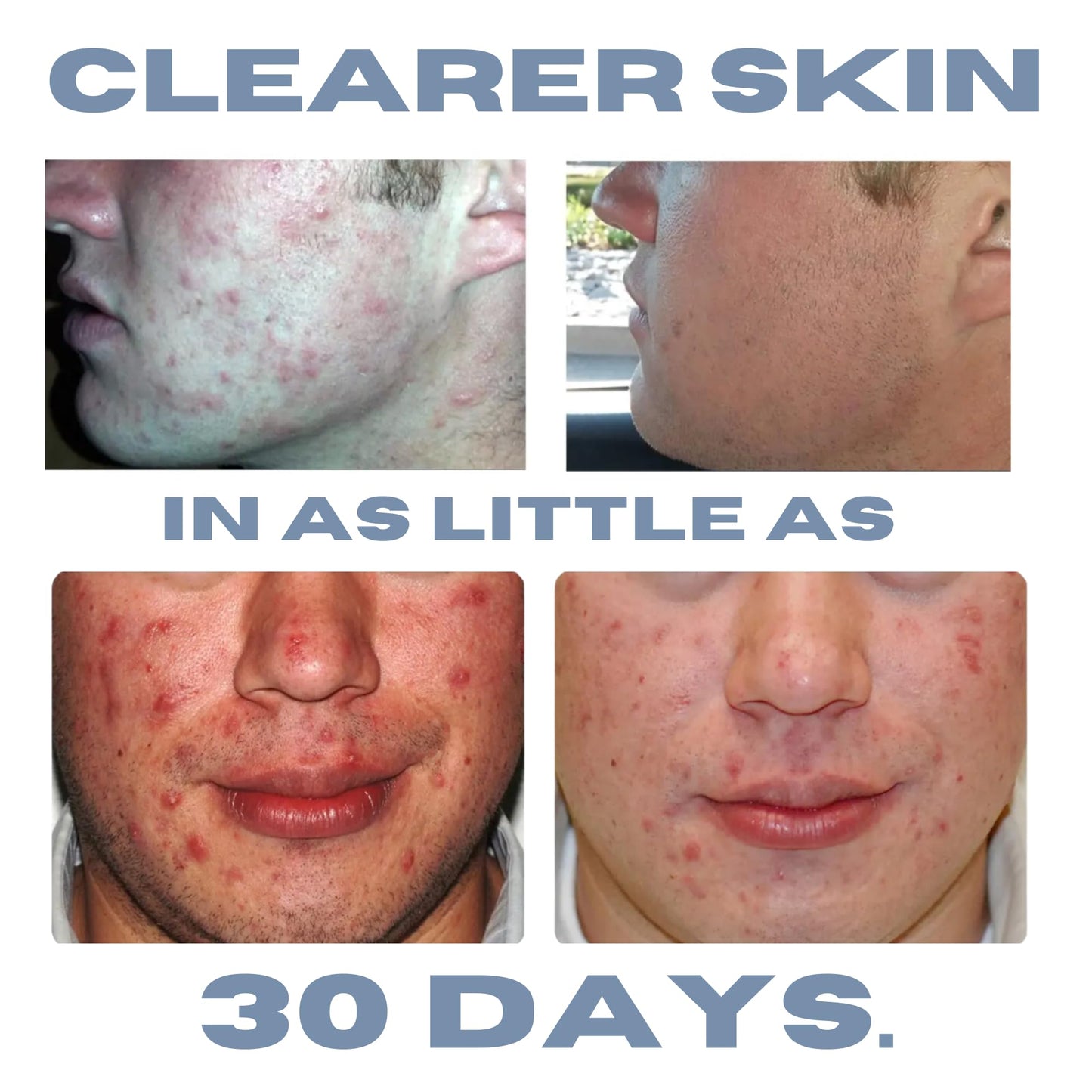 Clearogen Acne Lotion with Benzoyl Peroxide, Acne Cream, Face Moisturizer Acne Prone Skin, Acne Moisturizer for Face, 1.8 Fl oz