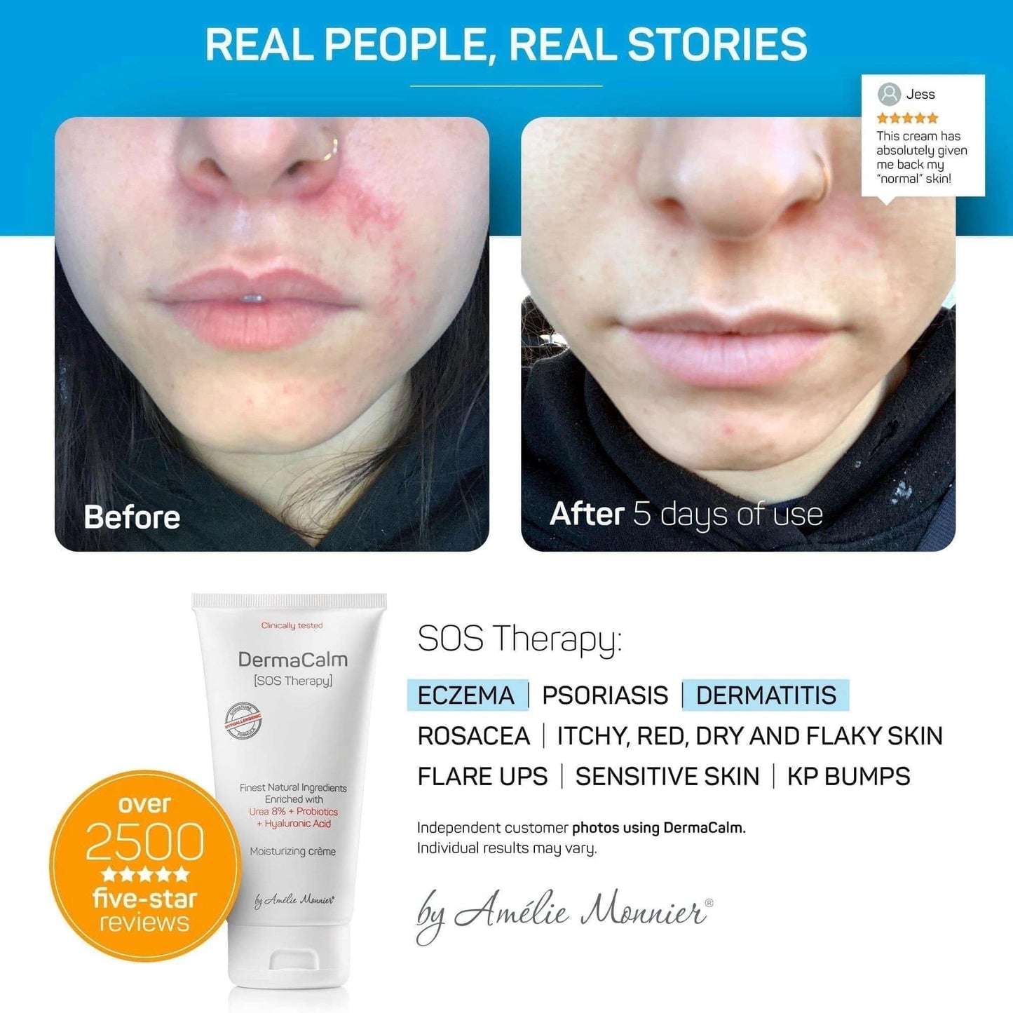 Clinically Tested DermaCalm SOS Therapy - Eczema Psoriasis Dermatitis Prone, Dry Skin - Urea 8%, Probiotics w/Best Natural Ingredients - Itchy, Severely Dry, Scaly Skin. Adults & Kids, Eczema Cream