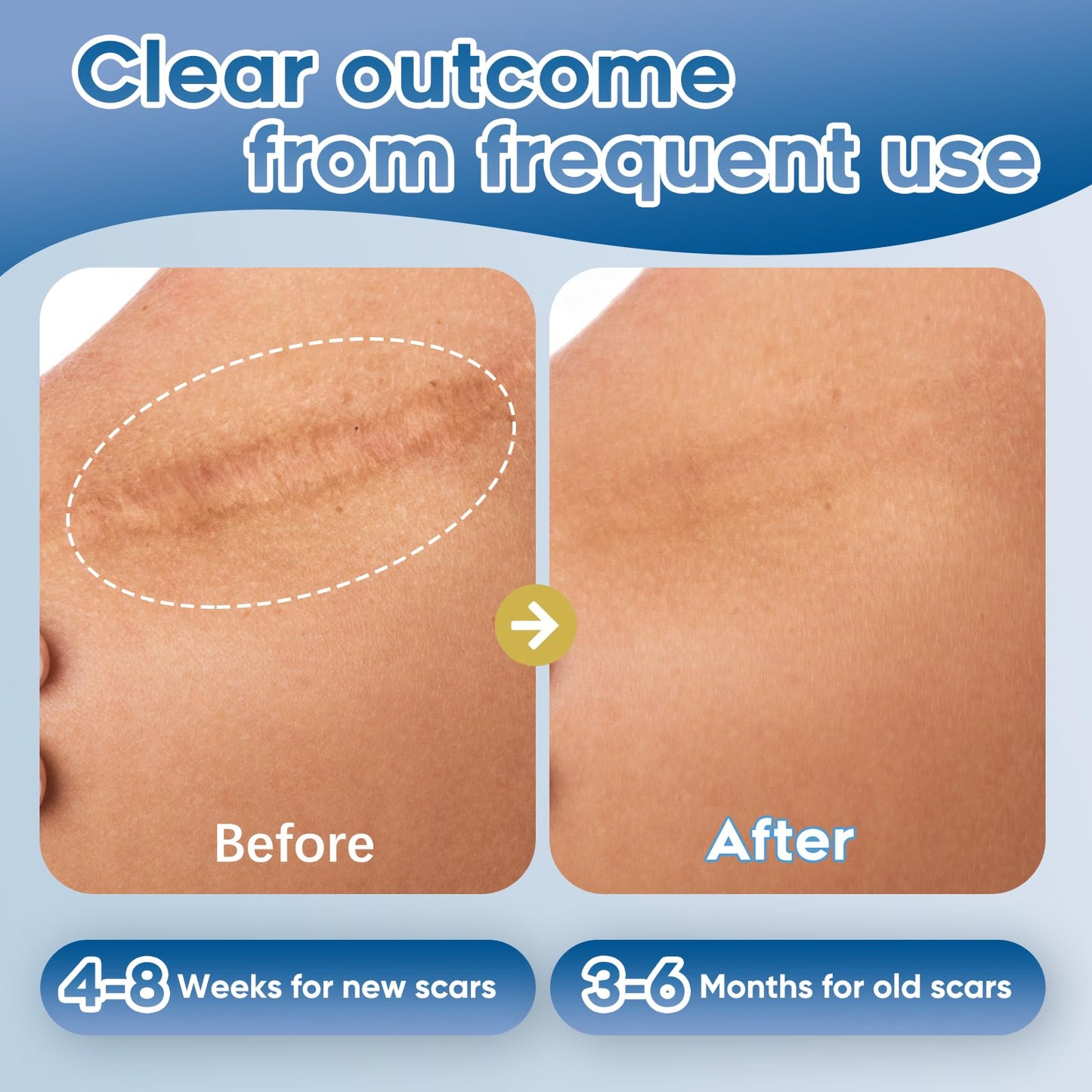 Advanced Silicone Scar Gel for Face & Body – Silicone Scar Cream for Old & New Scars, Reduces Appearance of Scars from Acne, Surgery, Burns, Injuries, C-Sections & More – 3.53 oz (100g)