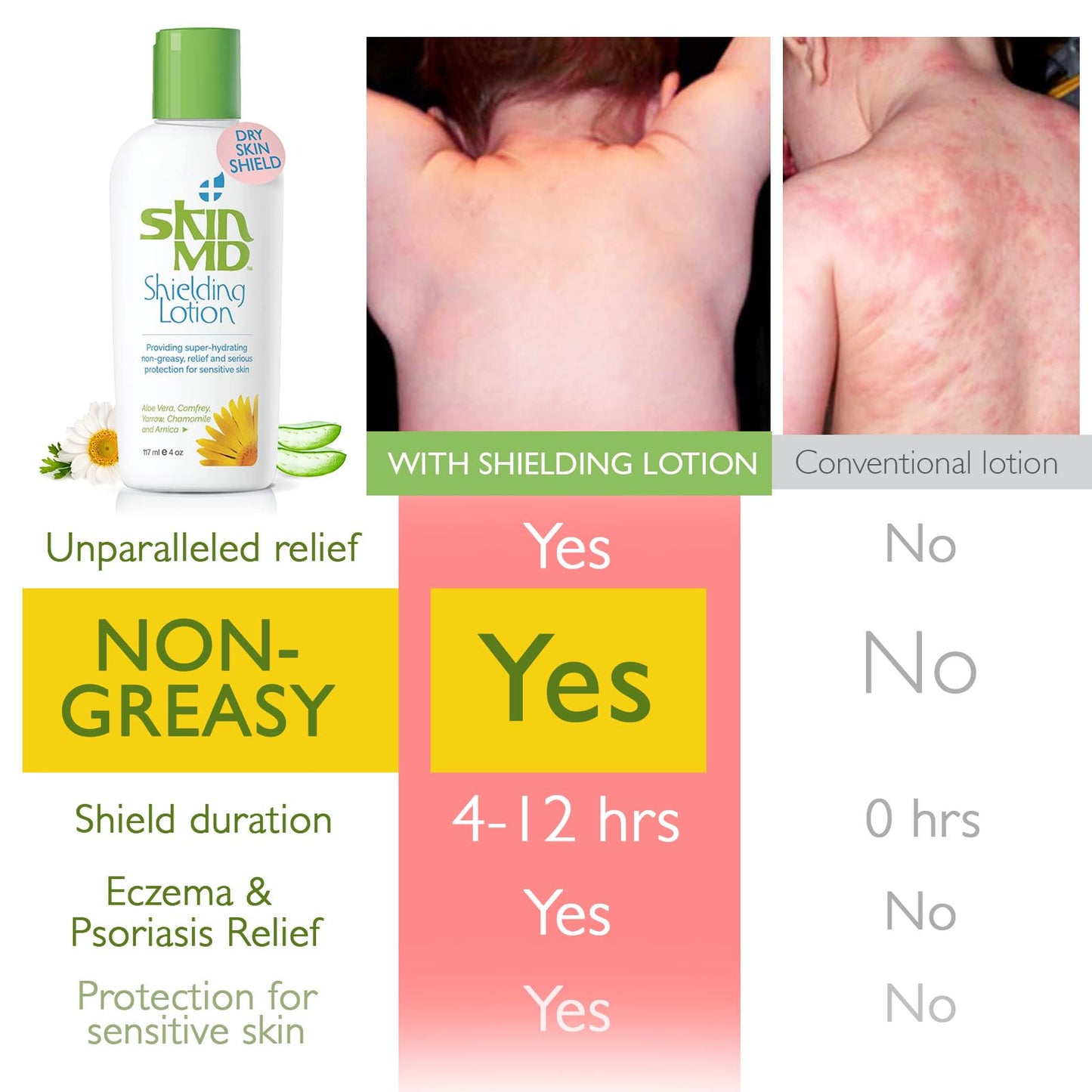 Skin MD Shielding Lotion Hydrating Body Lotion for Sensitive Skin with Dispenser | Non-Greasy, Fast-Absorbing Moisturizer with Plant-Based Ingredients, Eczema & Psoriasis Relief - 8oz