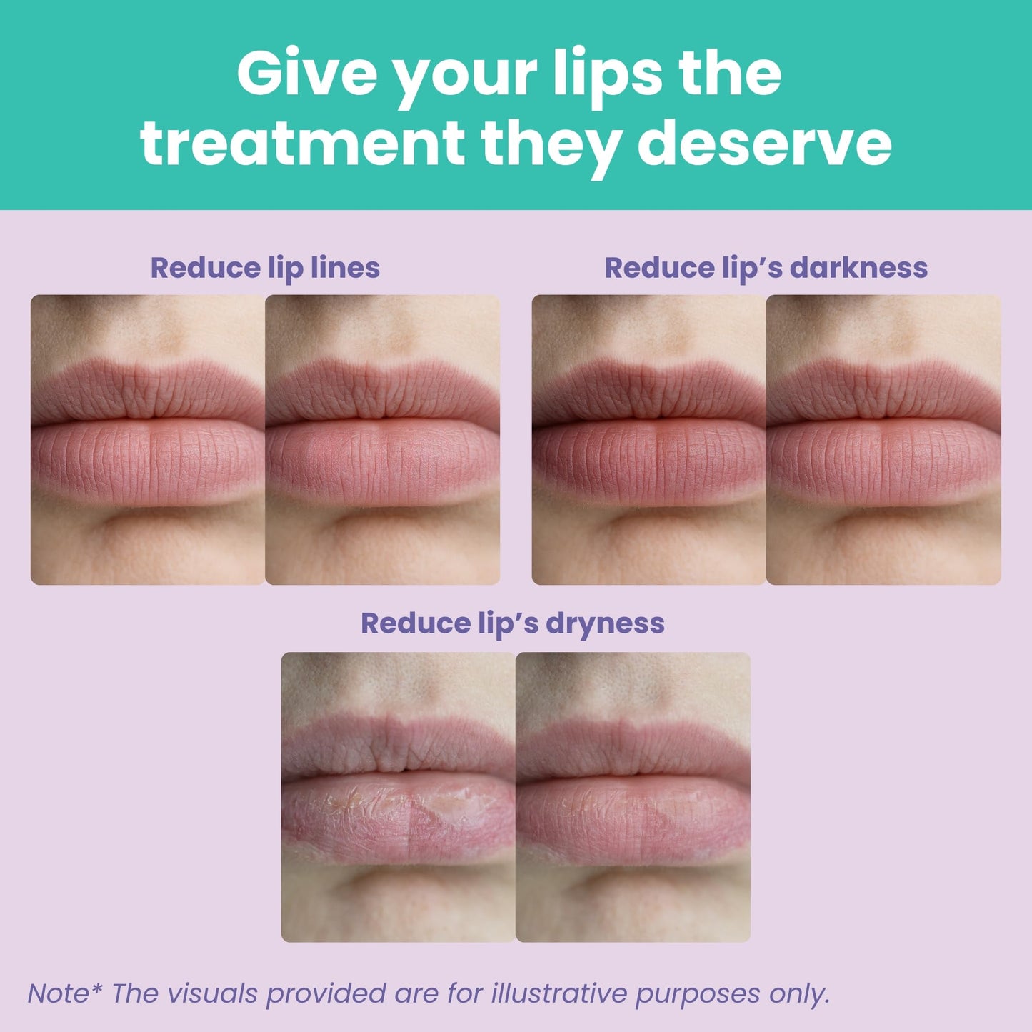 Patchology Moodpatch Keep Smiling Lip Mask - Hydrating gels with Sweet Violet, Lavender Petal & Coconut Extract for Soothing Aromatherapy - Moisturizing, Lip Primer - Ideal Bridesmaid Gifts - 5 Count