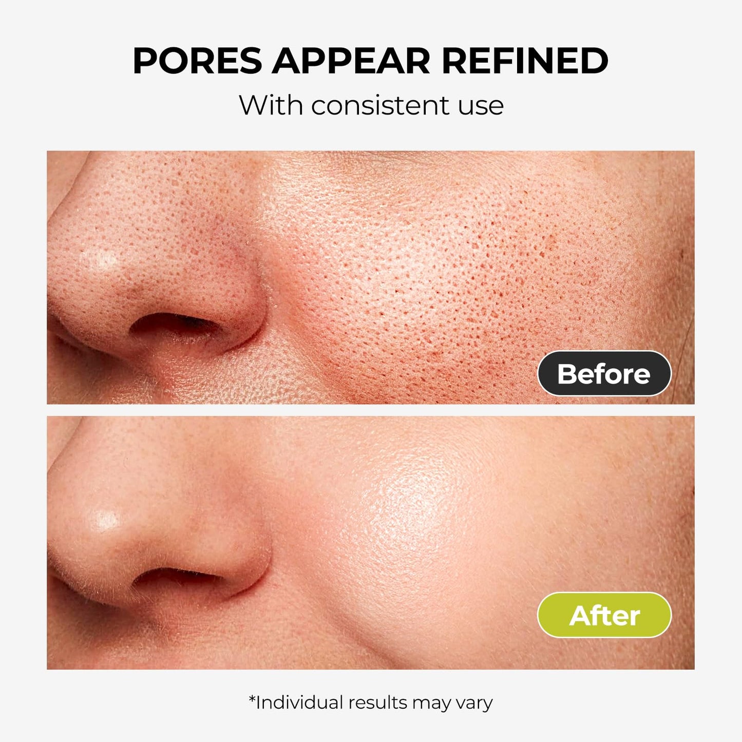 2% Salicylic Acid Serum for Face: Acne & Blackhead Remover, Pore Reducer for Oily & Acne Prone Skin, Gently Exfoliating Facial Serum with Witch Hazel, 1.01 Fl Oz.Drop
