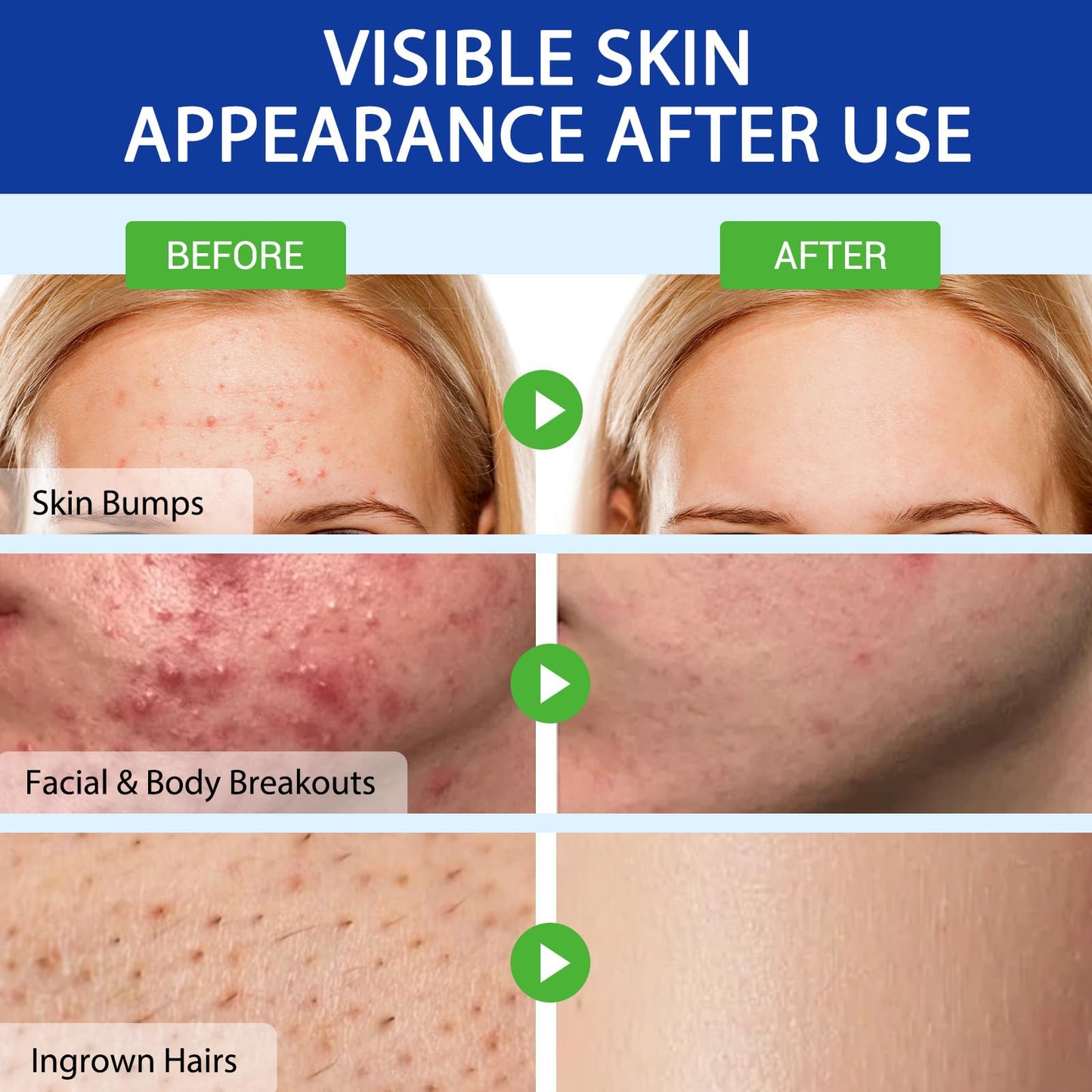 Folliculitis & Acne Treatment Cream Salicylic Acid & Herbal Extracts for Scalp, Face, Body & Back Soothes Redness, Itch & Irritated Skin-120g