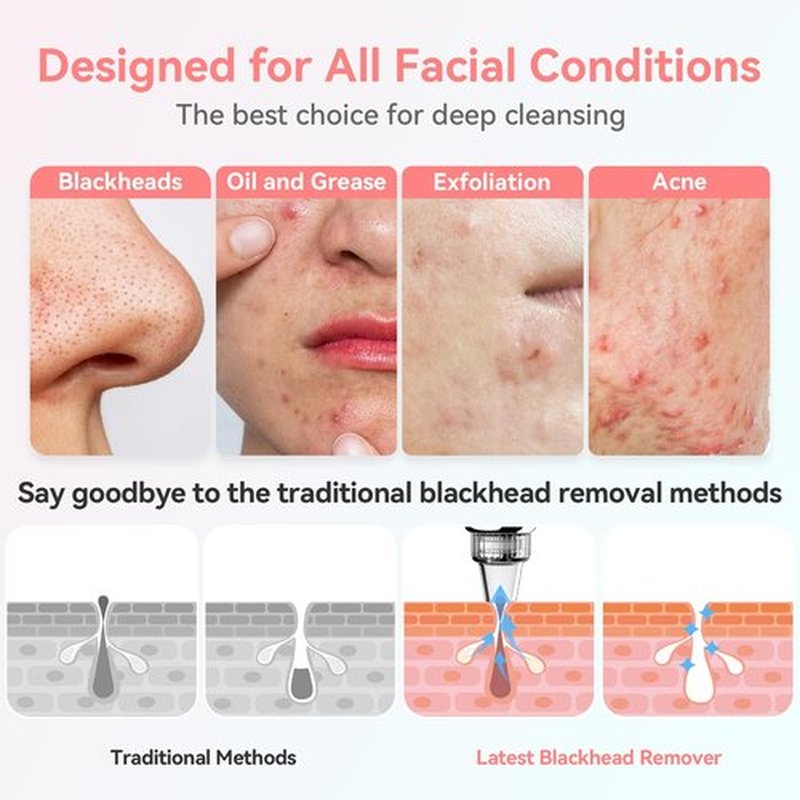 Blackhead Remover Pore Vacuum Upgraded Facial Pore Cleaner Electric Comedone Whitehead Extractor Tool-5 Suction Power,5 Probes,USB Rechargeable Blackhead Vacuum Kit for Women & Men