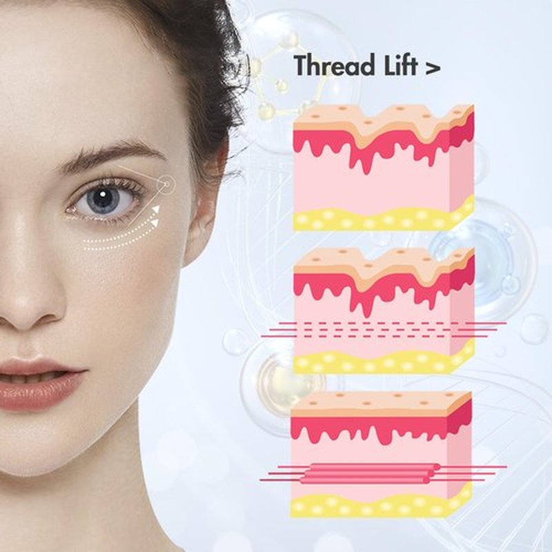 ESTEVO PDO Eyes Thread Lift, Improves Fine Lines and Wrinkles Get Youthful PDO Threads Lift for Eyes (20PCS-30G*38mm)