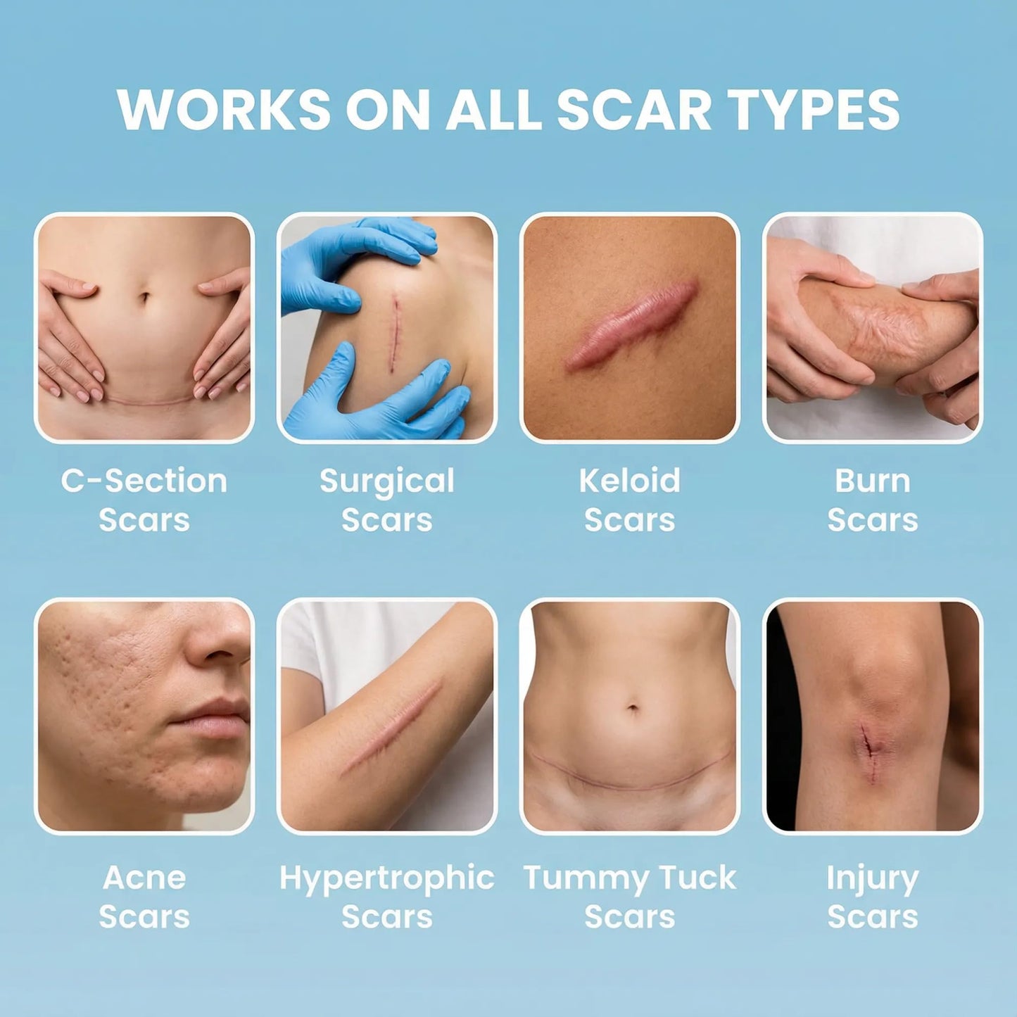 Soft, Medical Grade Silicone Tape for Scars (1.6” x 120”) - Reduce The Appearance of Surgical, C Section, Hypertrophy, Keloid Scars, & Acne Scars - Silicone Scar Tape for Surgical Scars, (3 Pack)