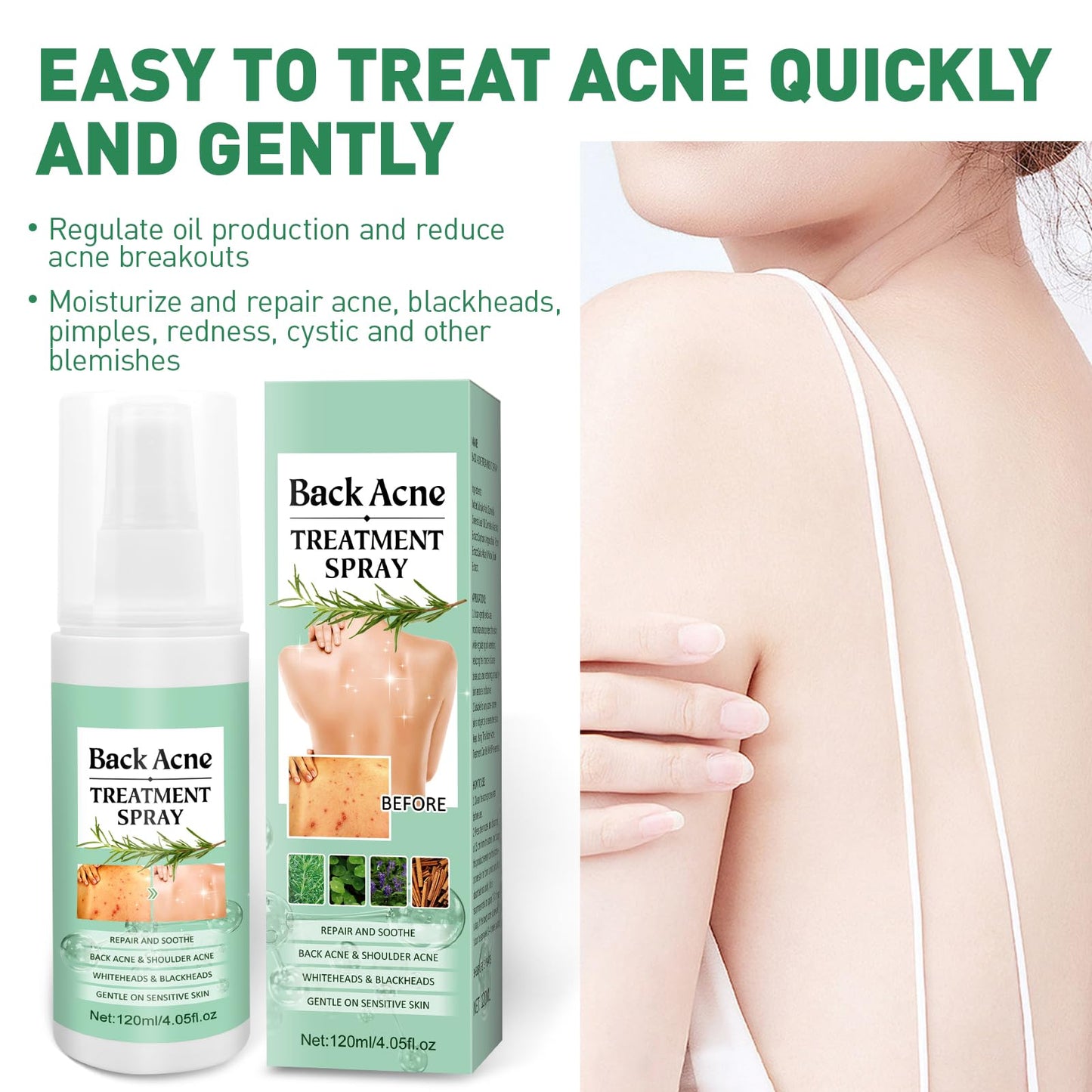 Back Acne Treatment Spray With Herbal Formula, 2% Salicylic Acid & Tea Tree Oil - Body Acne Solution, 120ml