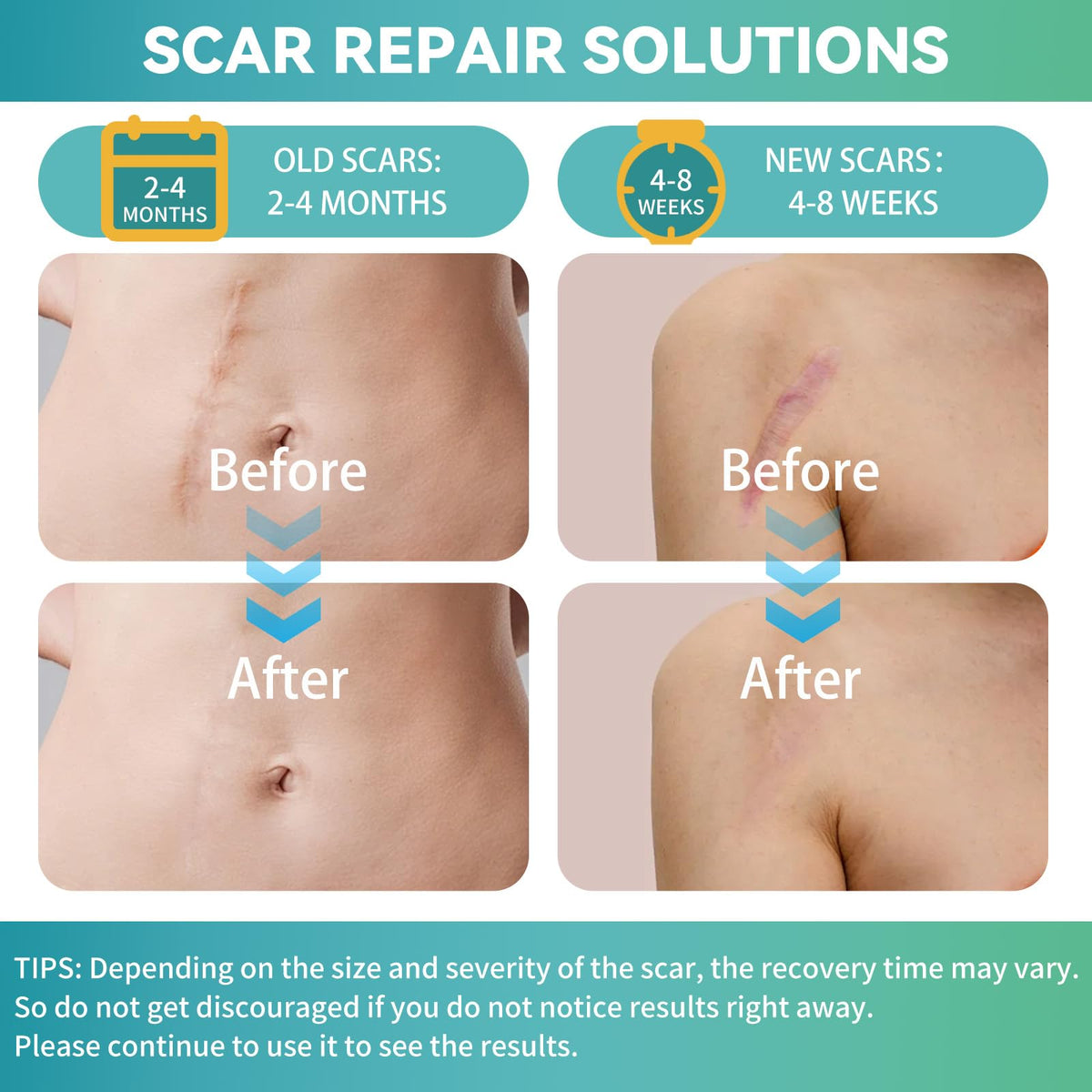 Silicone Scar Tape, Silicone Scar Sheets(1.6"X 60" Roll-1.5M), Silicone Scar Sheets for Face, Reusable Medical Grade Silicone Tape for Scars, C-Section, Keloid, Acne, Tummy Tuck, Surgical Scars, Light