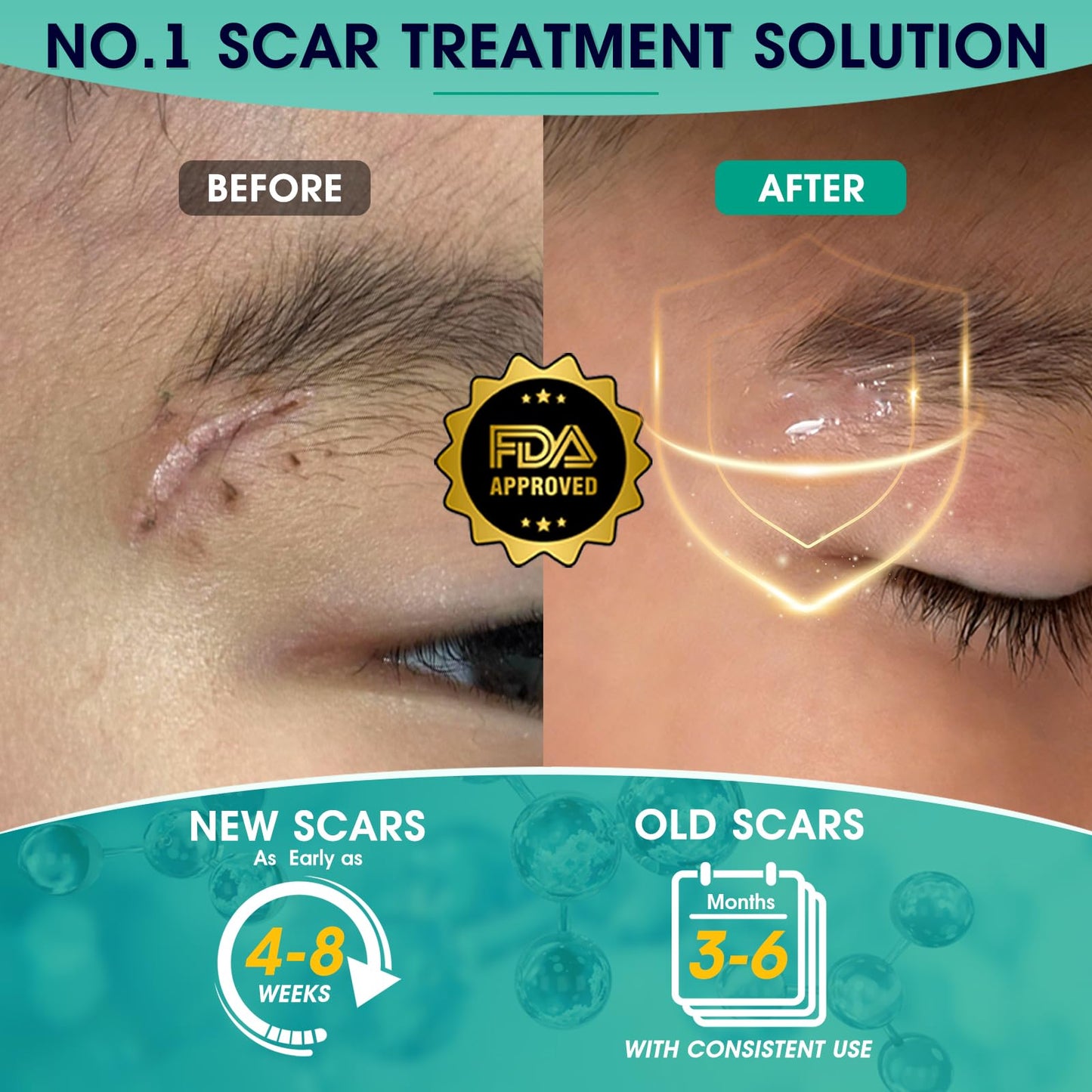 ScarMD Silicone Scar Gel Roll-On, 100% Pure Scar Cream, Advanced Scar Cream for Surgical Scars, Keloids & Stretch Marks | Clinically Proven Treatment for Old & New Scars