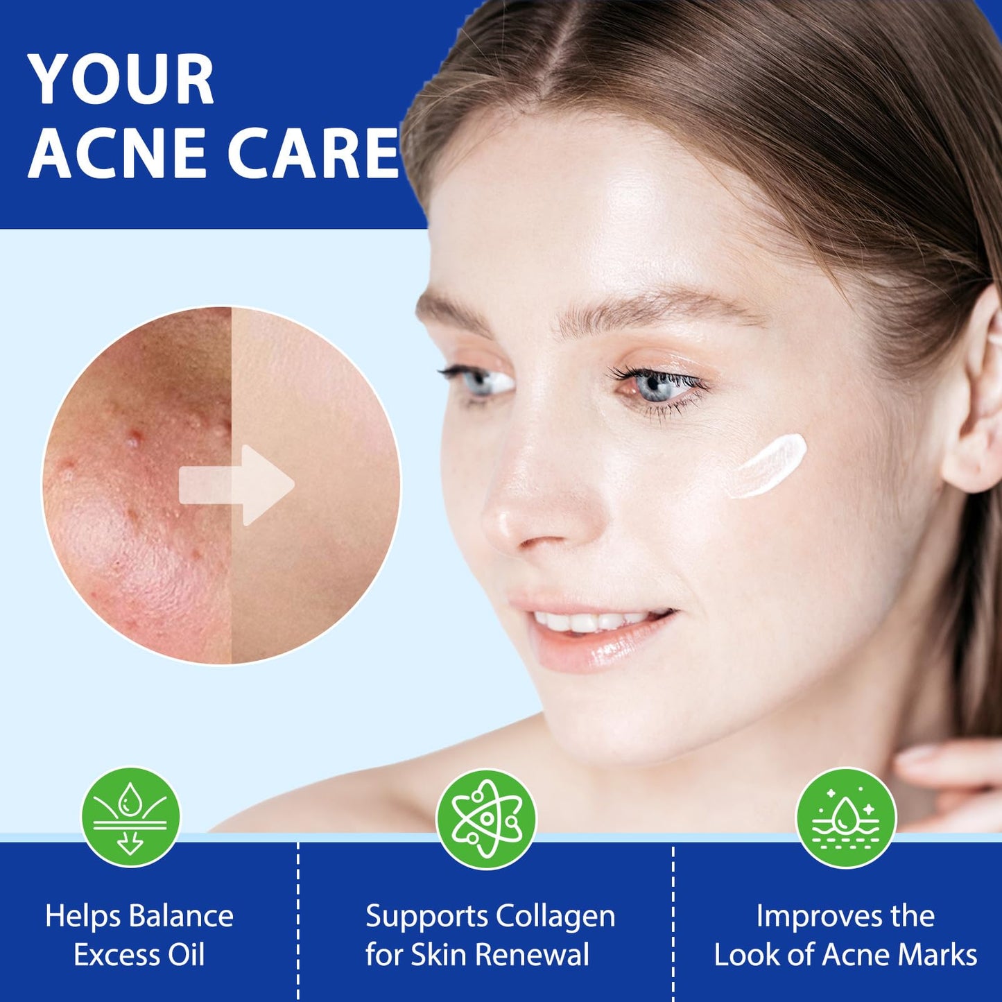 Folliculitis & Acne Treatment Cream Salicylic Acid & Herbal Extracts for Scalp, Face, Body & Back Soothes Redness, Itch & Irritated Skin-120g