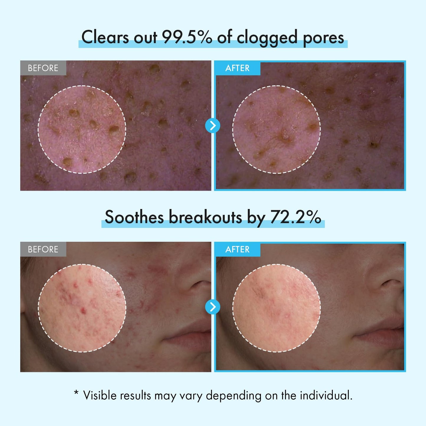 TOSOWOONG Azelaic Acid Niacinamide Face Wash for Blemish-Prone Skin, Pores