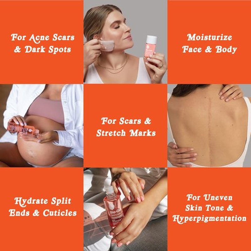 Bio-Oil Skincare Body Oil, Serum for Scars and Stretchmarks, Face Moisturizer Dry Skin, Non-Greasy, Dermatologist Recommended, Non-Comedogenic, For All Skin Types, with Vitamin A, E, 4.2 oz
