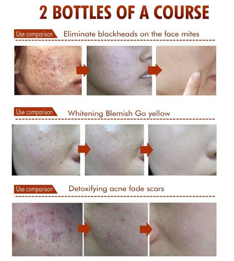 BIOAQUA Acne Scar Blemish Gel Spot Removal Oil Control Face Cream