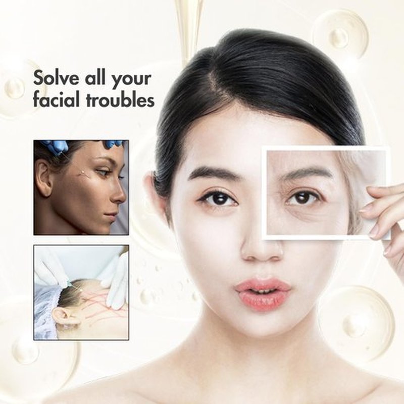 ESTEVO PDO Eyes Thread Lift, Improves Fine Lines and Wrinkles Get Youthful PDO Threads Lift for Eyes (20PCS-30G*38mm)