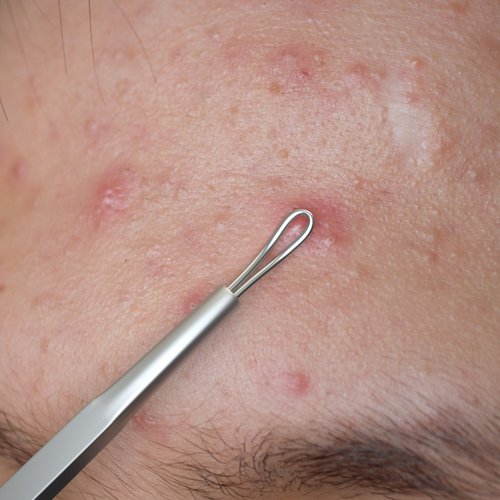 Suvorna Blackhead Extractor Loop, Milia Remover, Nose Blackhead Remover Tool, Whitehead Extractor, Pore Extractor, Black Head Remover for Face, Pore Cleaner, Pimple Popper Tool, Pimple Extractor