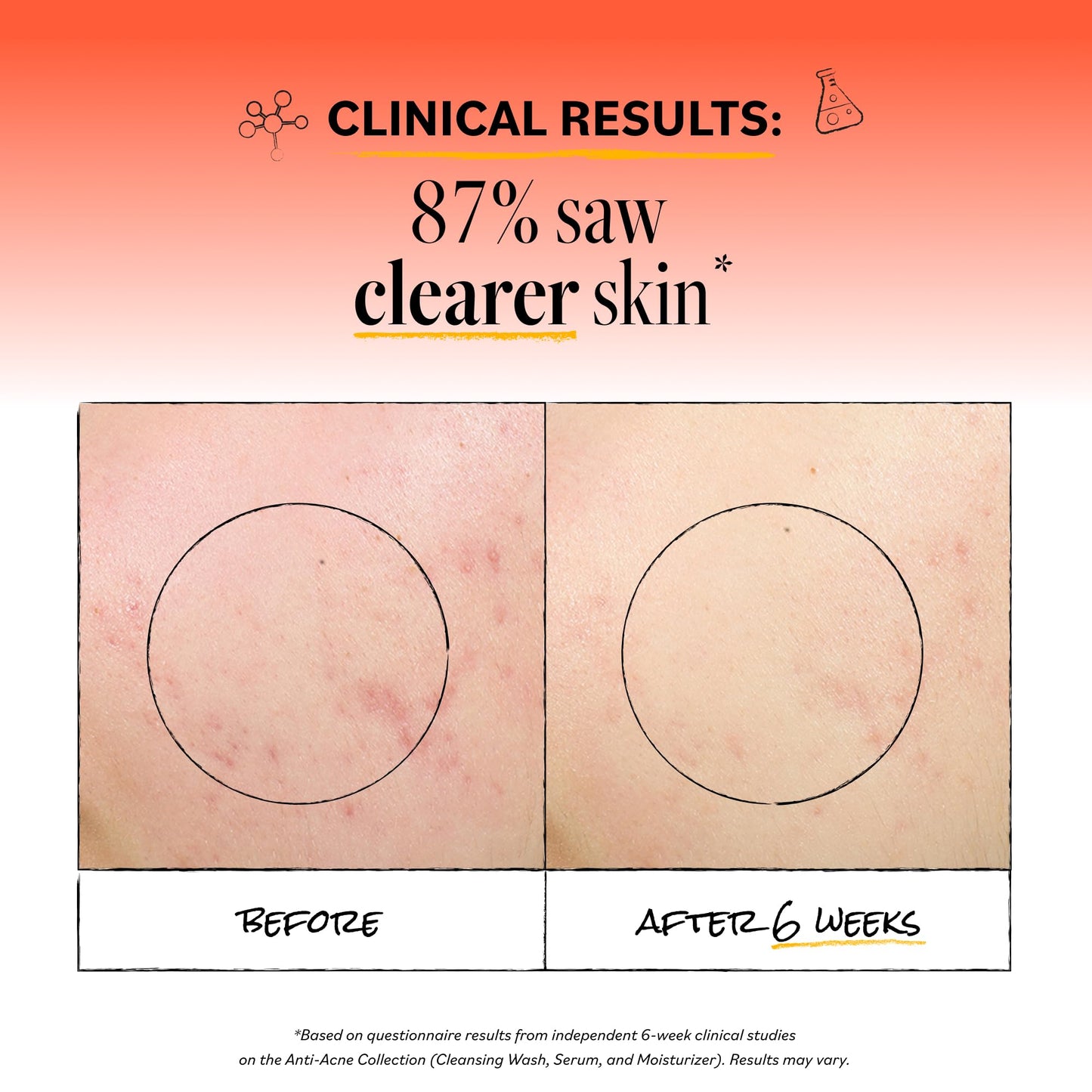 Derma E Acne Deep Pore Cleansing Wash – Blemish Control Facial Cleanser with Salicylic Acid - Gentle Oil Control Face Wash Soothes and Balances Skin, 6 fl oz