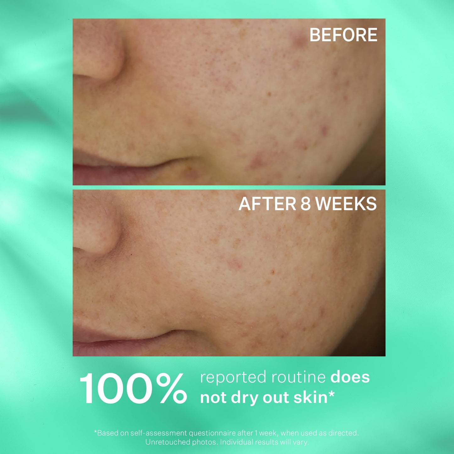 StriVectin Acne Control System Set with Cleanser, Lotion & Toner, Multi Action Clear for Acne and Blemish Prone Skin for Clearer, Smooth and Brighter Skin, Less Breakouts and Pimples - 3 Piece Set