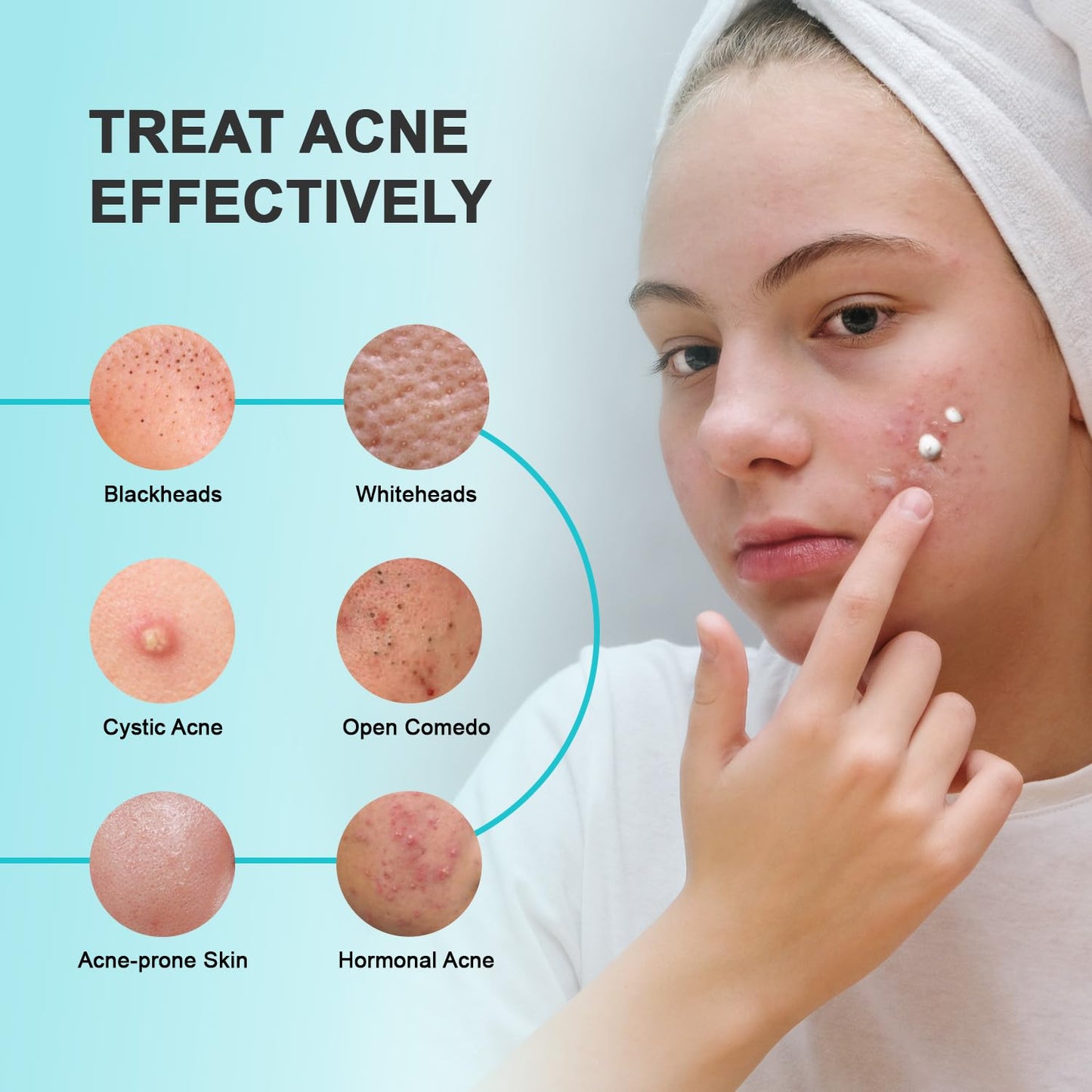 Acne Pimple Spot Treatment Cream: Cystic Hormonal Breakouts Control for Face & Back - 2% Salicylic Acid, Fast Redness Relief, Fades Blemishes & Post-Acne Marks, Teens-Adults, 1.8 oz