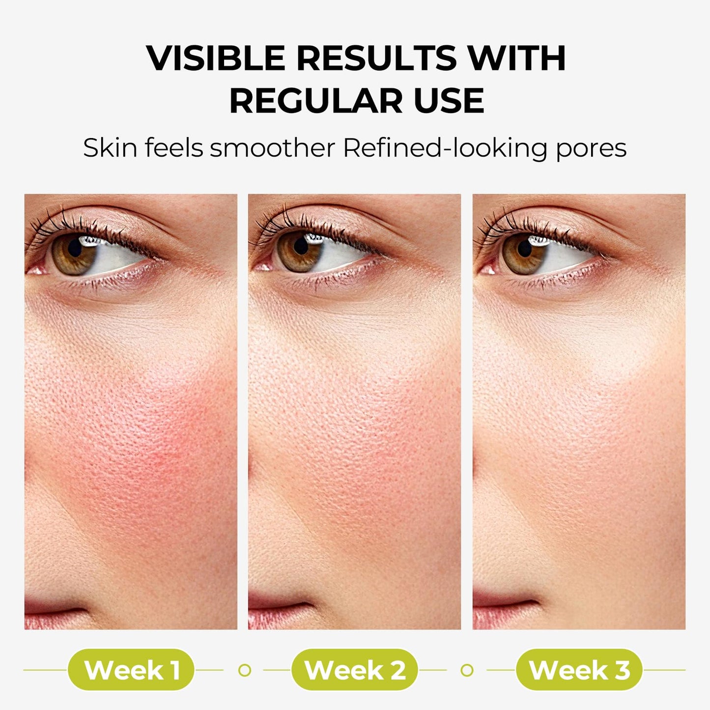 2% Salicylic Acid Serum for Face: Acne & Blackhead Remover, Pore Reducer for Oily & Acne Prone Skin, Gently Exfoliating Facial Serum with Witch Hazel, 1.01 Fl Oz.Drop