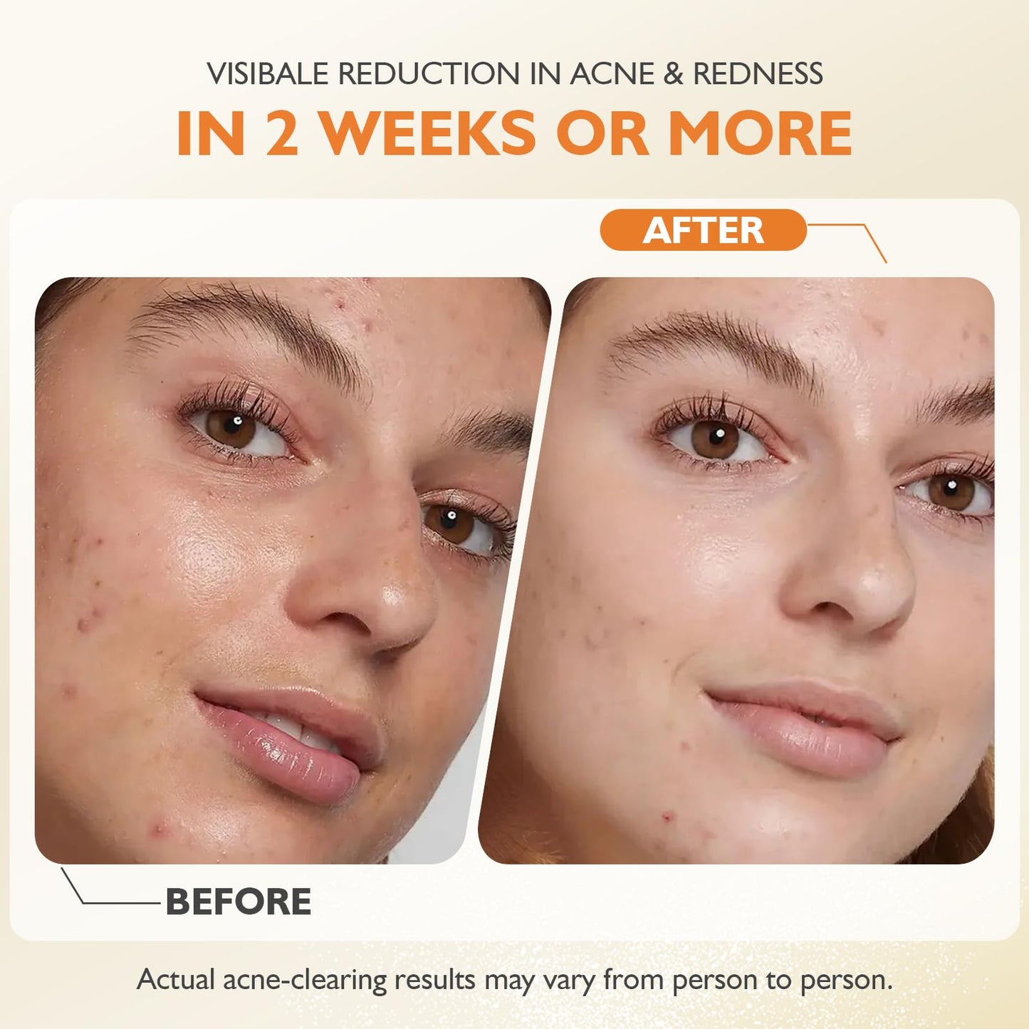 Organics Acne Killer Day Balm 2.0 – Natural Botanical Acne Treatment for Face, Body & Back | Reduces Pimples, Blackheads & Redness | Balancing, Hydrating