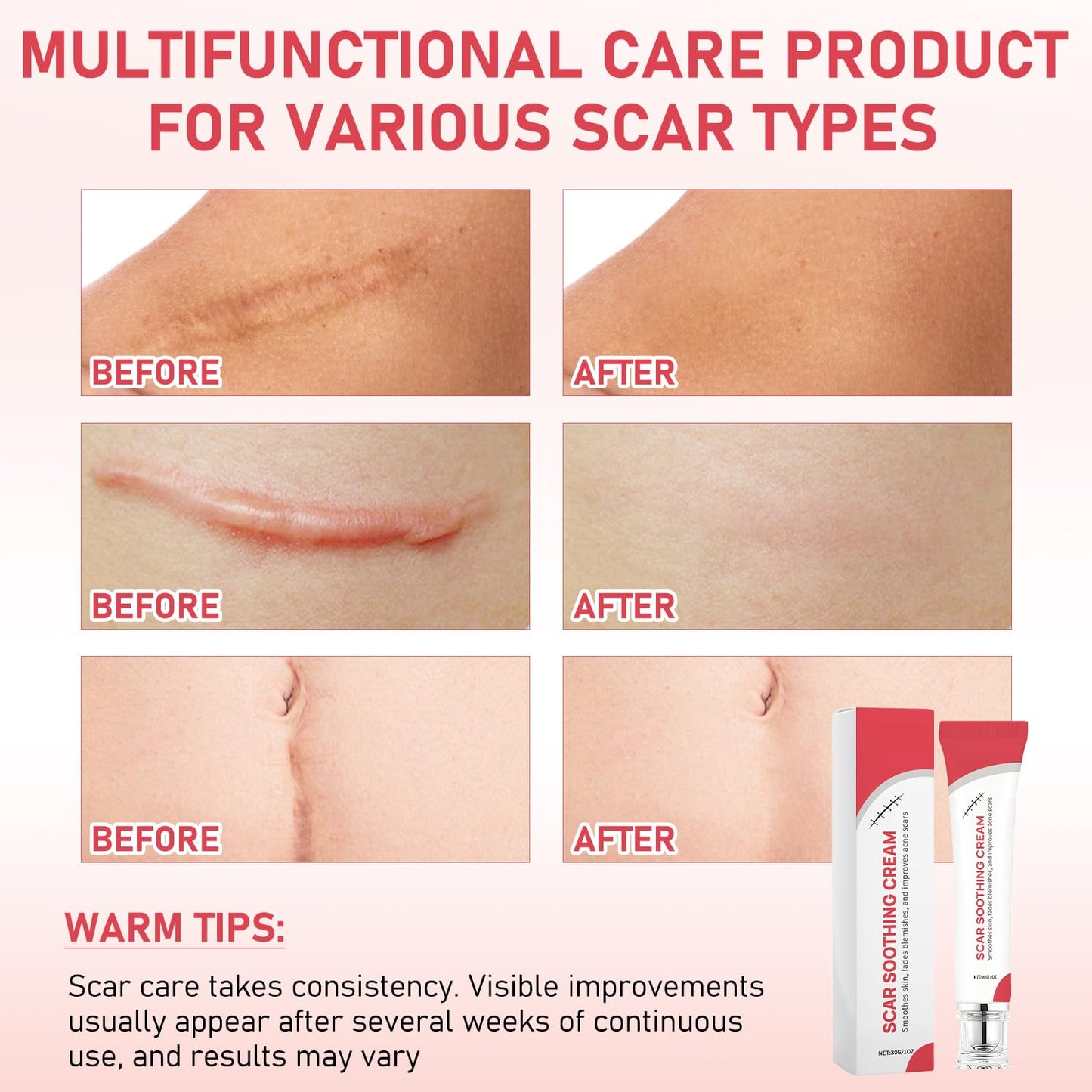 2PCS Scar Soothing Cream & Smoothing Cream for Scars - Gentle Care for Sensitive, Helps Improve Appearance of Scars, For Recover Smooth, Lightweight Non-Greasy Formula