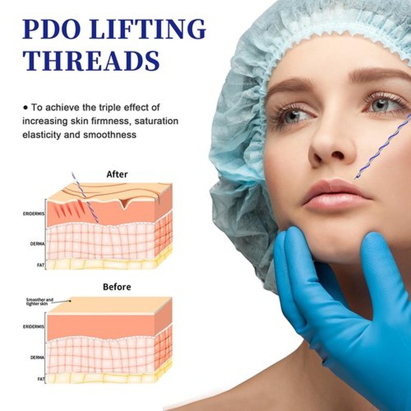 SOZOOM PDO Screw Threads, PDO Thread Lift Korea Pdo Threads Whole Body Lifting (100PCS-27G-50mm)