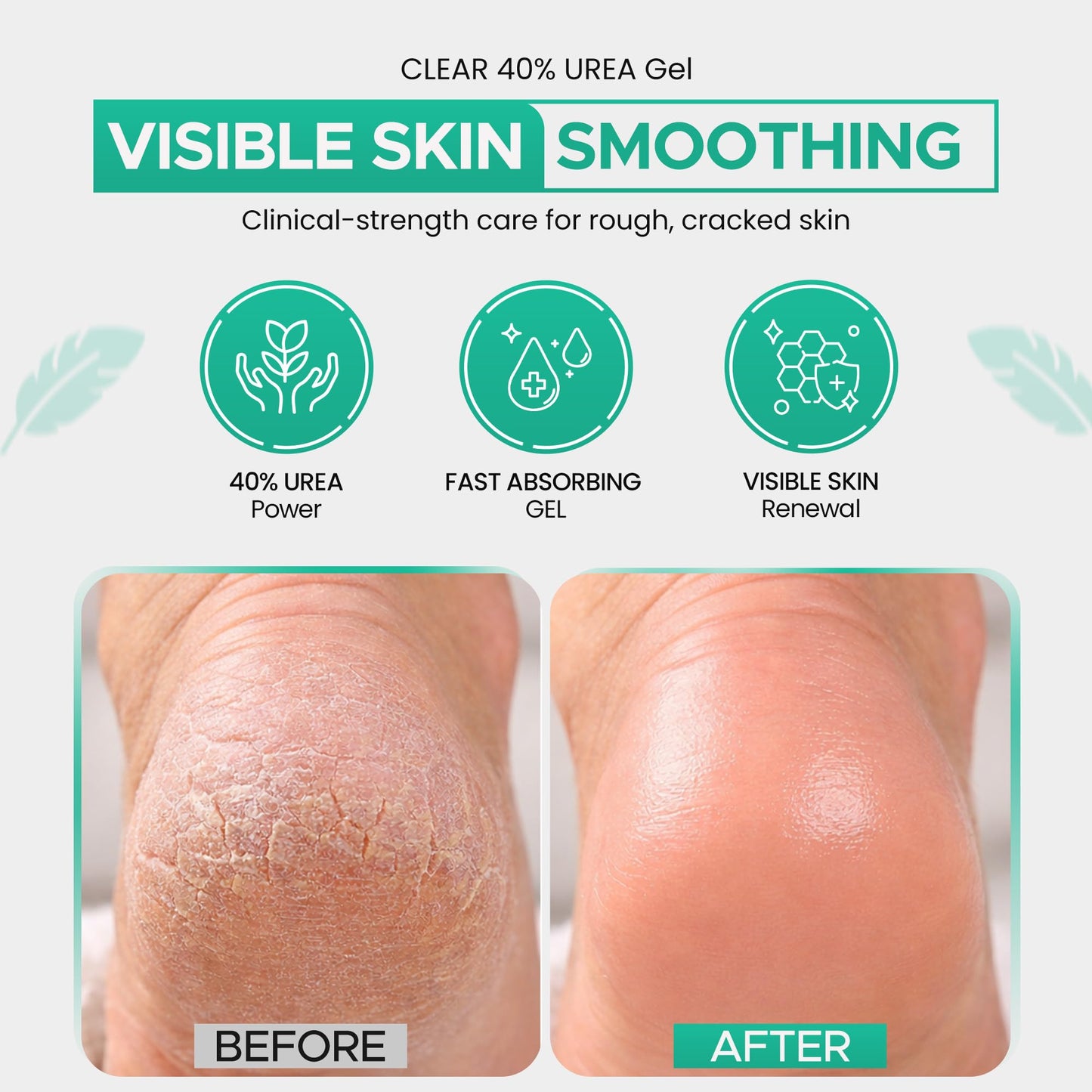 CLEAR 40 Urea Gel 40% (4 oz) with Tea Tree & Coconut Oil & Aloe Vera – Intensive Moisturizing & Exfoliating Gel for Dry Rough Skin, Feet, Heels, Elbows, Hands & Nails – Fast Absorbing Hydration