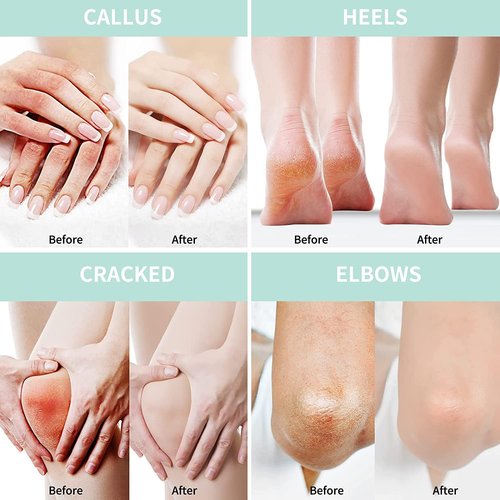 Urea Cream 20 Percent For Feet Plus 2% Salicylic Acid 8.82 oz || Foot Cream and Hand Cream Maximum Strength with Hyaluronic Acid, Tea Tree, and Aloe Vera for Deep Moisturizes, Callus Remover