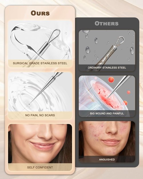 SGNEKOO Blackhead Remover Tweezers, Precision Pimple Popper Tool Kit 3 in 1, Titanium Alloy Black Head White Head Extractor for Face, Professional Comedone Extractor Kit for Blemish,Zit,Acne