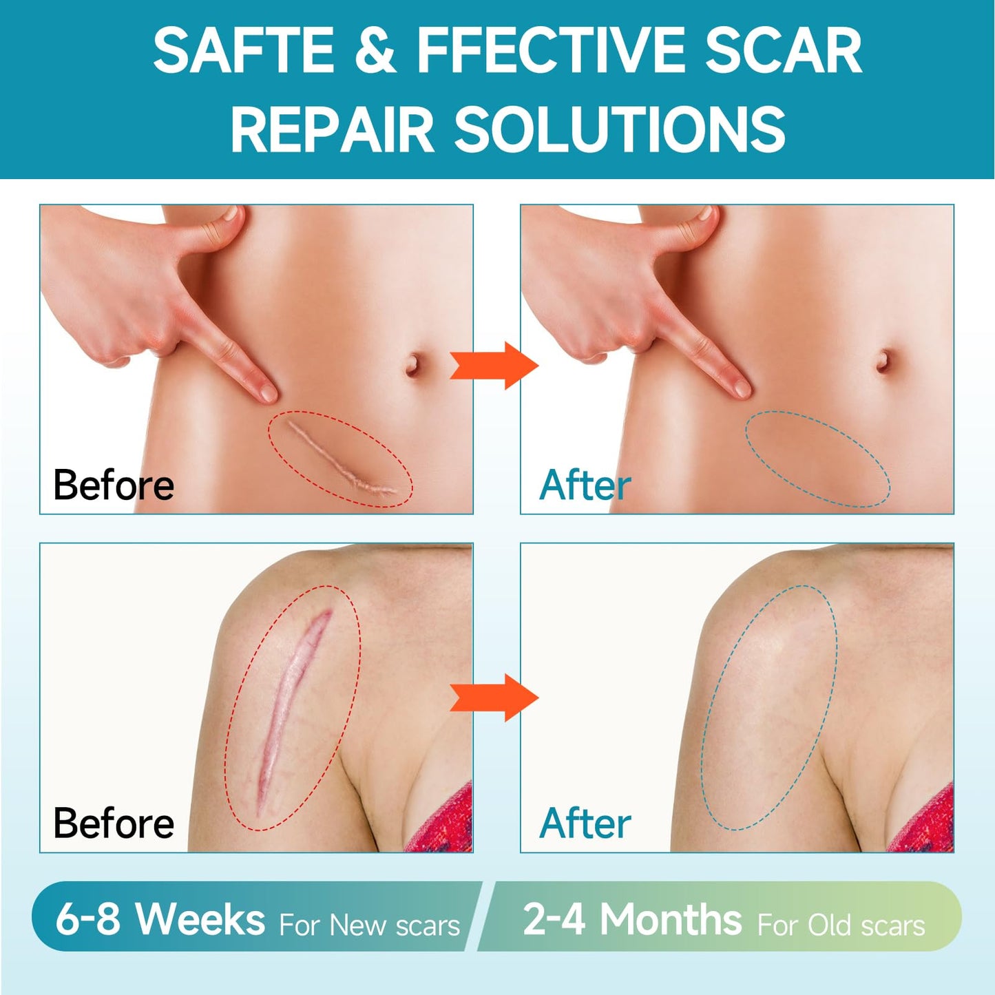 Silicone Scar Sheets, Silicone Scar Tape (1.6"x60 " Roll-1.5M) Reusable Professional Scar Silicone Strips Soft Silicone Scar Patches for Scar Removal Treatment, Surgical Scars, Keloid, C-Section, Burn