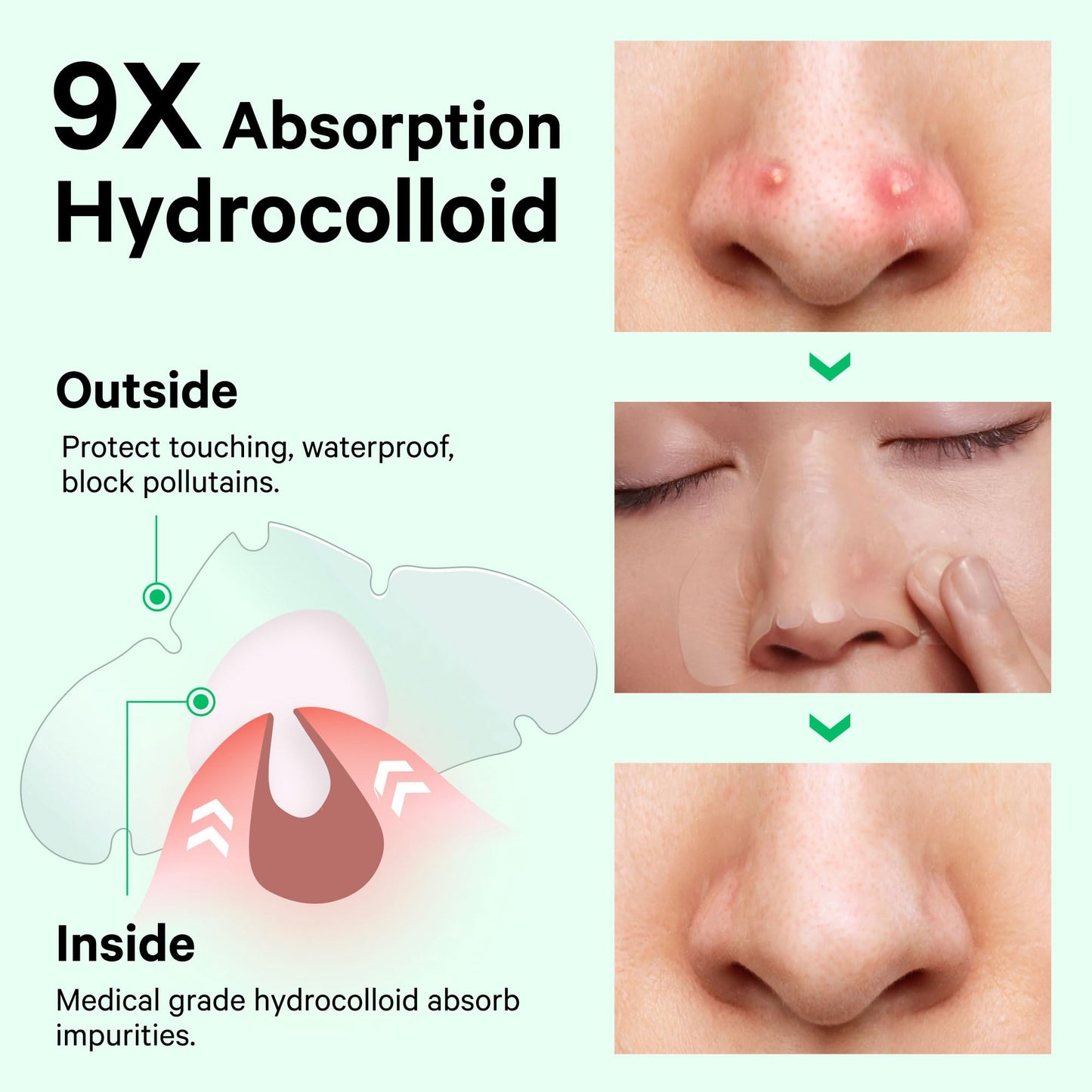 Sosky Pimple Patches for Nose Overnight Acne Pore Strips Hydrocolloid Nose Patches Helps Control Oil, Targets Pimples & Blemishes, Clear Skin 8 Count