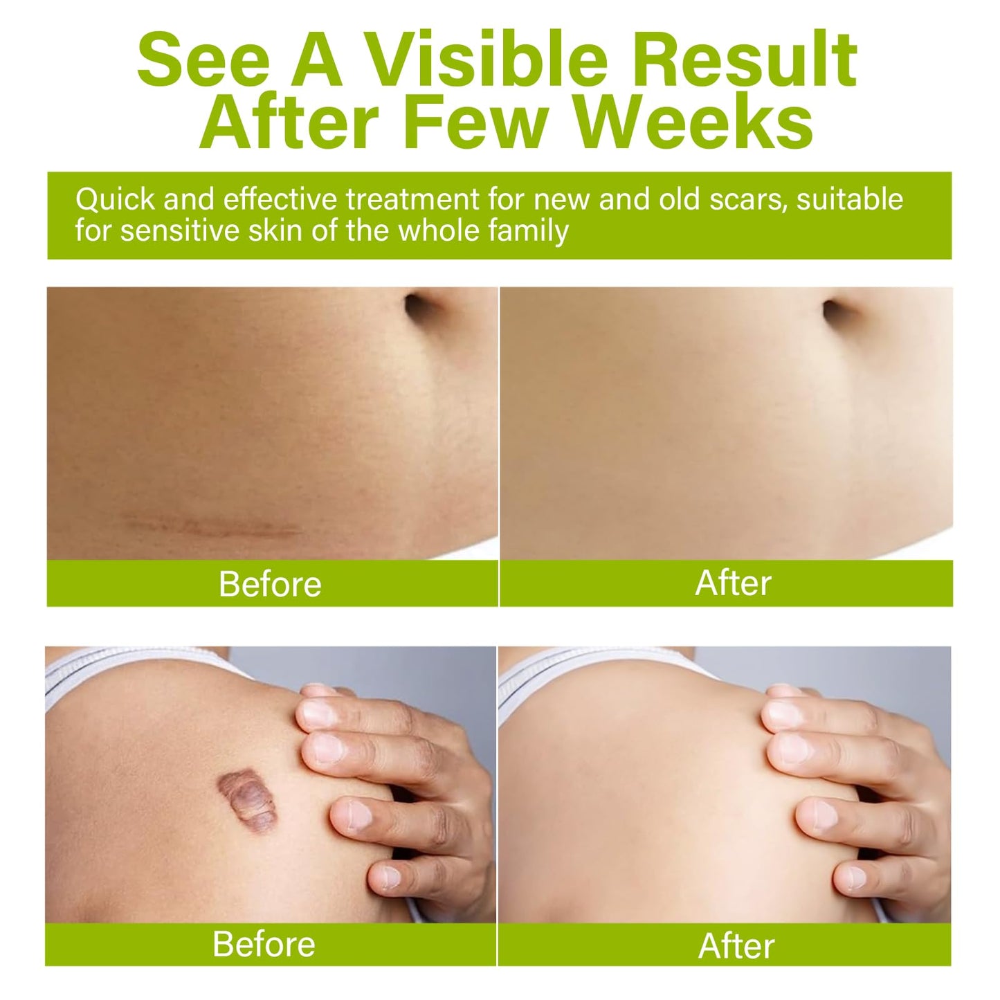 Keloid Bump Removal