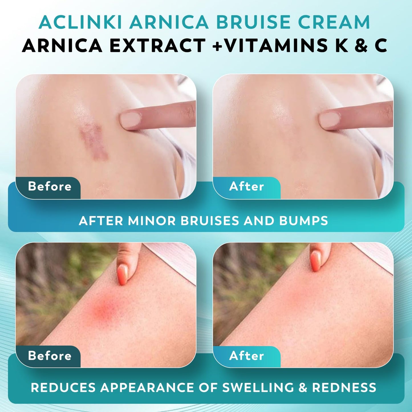 ACLINK Arnica Bruise Cream for Bruising & Swelling Relief, Arnica Montana with Vitamins K, C & E, Fast Absorbing Non-Greasy Moisturizing Cream for Thin Sensitive Skin on Face,Fragrance Free, 4.2 oz