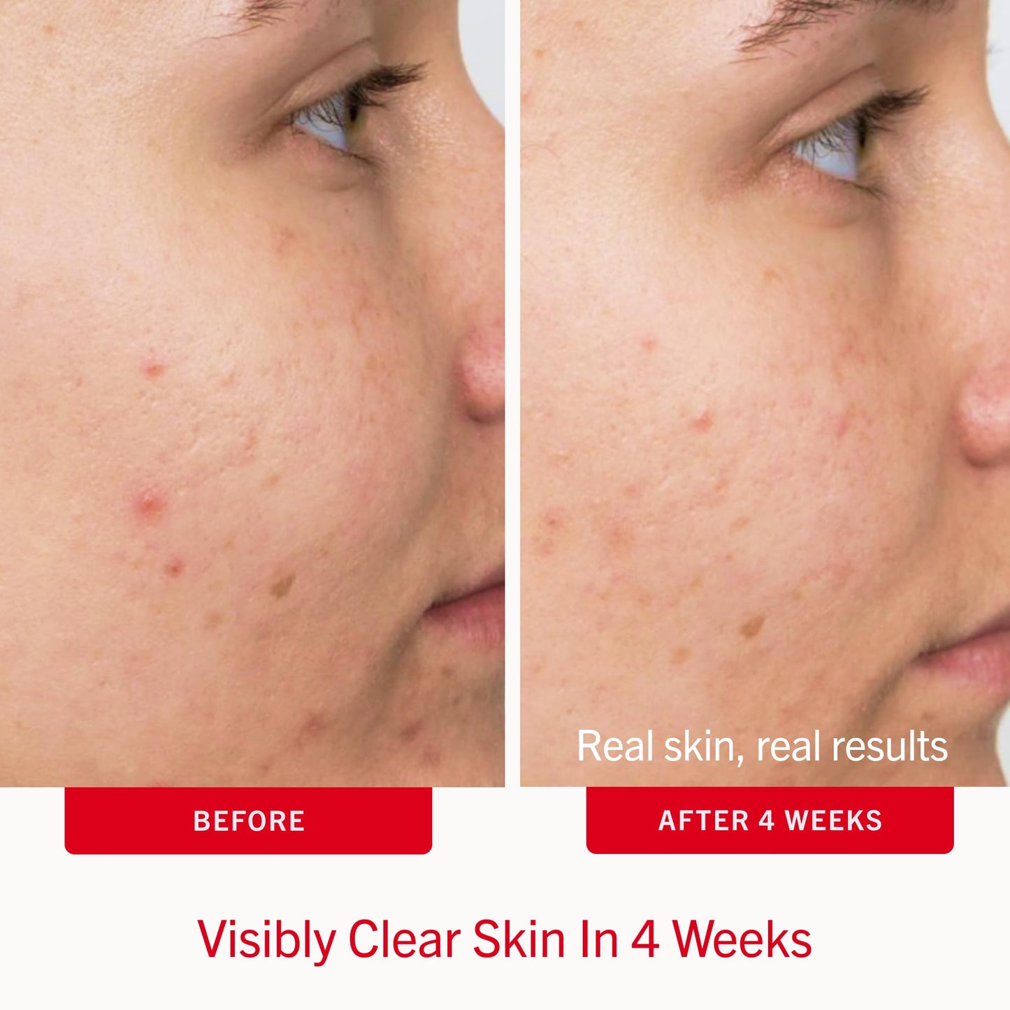 First Aid Beauty Acne Treatment Pads, 2% Salicylic Acid Maximum Strength Acne Pads for Face, Non-Drying Formula, Sensitive Skin, 60 ct